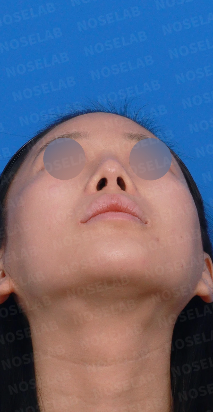 비중격 천공이 생기면 무엇이 문제이고 어떻게 재건하나 — 디자인 상담 우측 측면, 비스듬한 측면, 비공 사진입니다.
