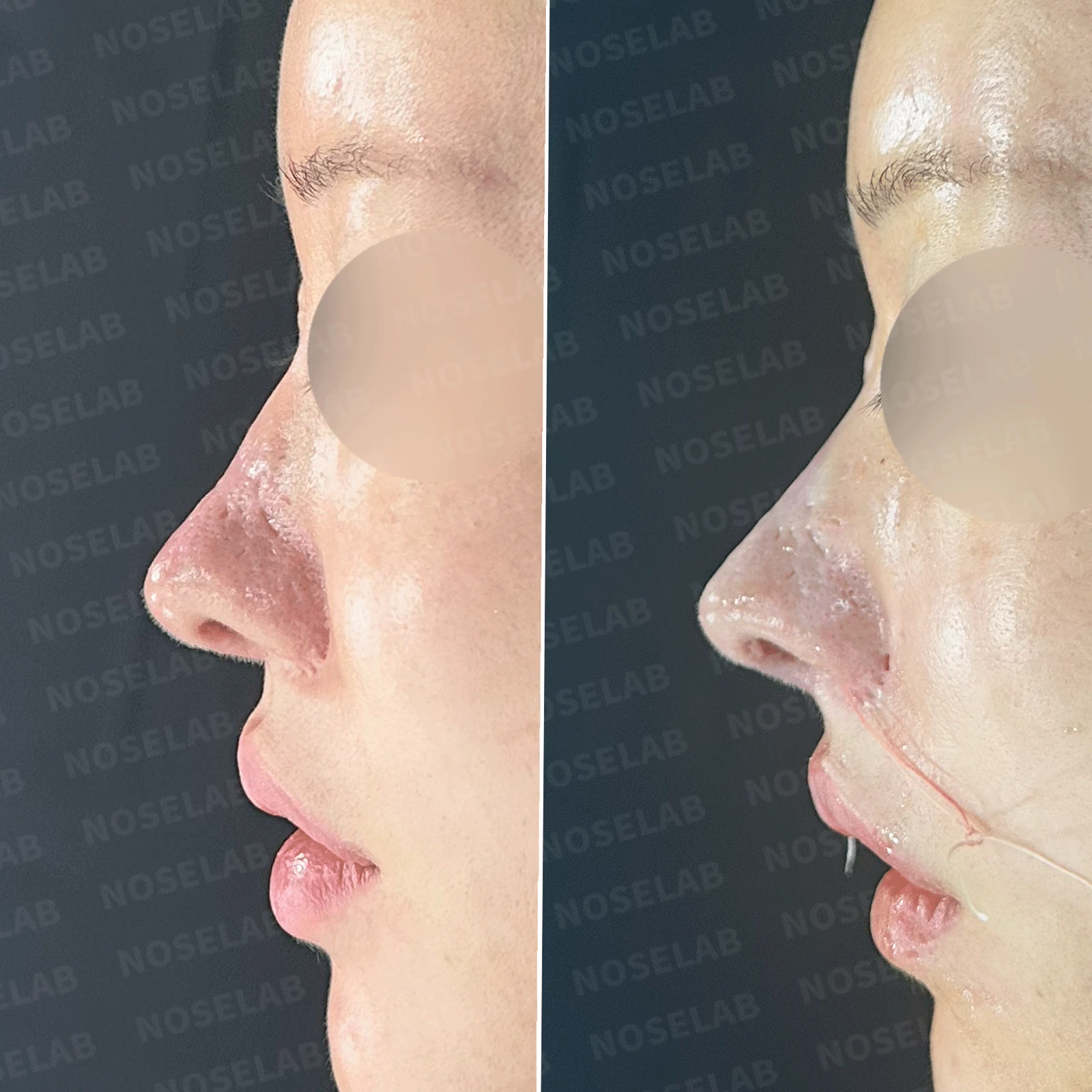 코 수술 뒤 콧등 피부가 괴사하면 어떤 변화가 남고, 재건은 어떻게 하나 — 본문 사진 20