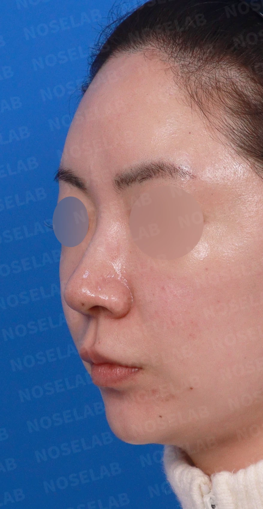 코끝이 퍼져 보이는 이유와 코바닥·비순각을 함께 다루는 방법 — 디자인 상담 정면, 좌측 측면, 비스듬한 측면 사진입니다.
