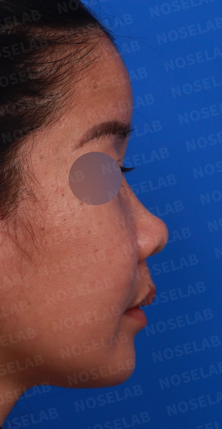 콧대가 평행선처럼 보이는 조건과 콧구멍 모양을 정하는 기준 — 디자인 상담 우측 측면 , 비스듬한 측면 , 비공 사진입니다.