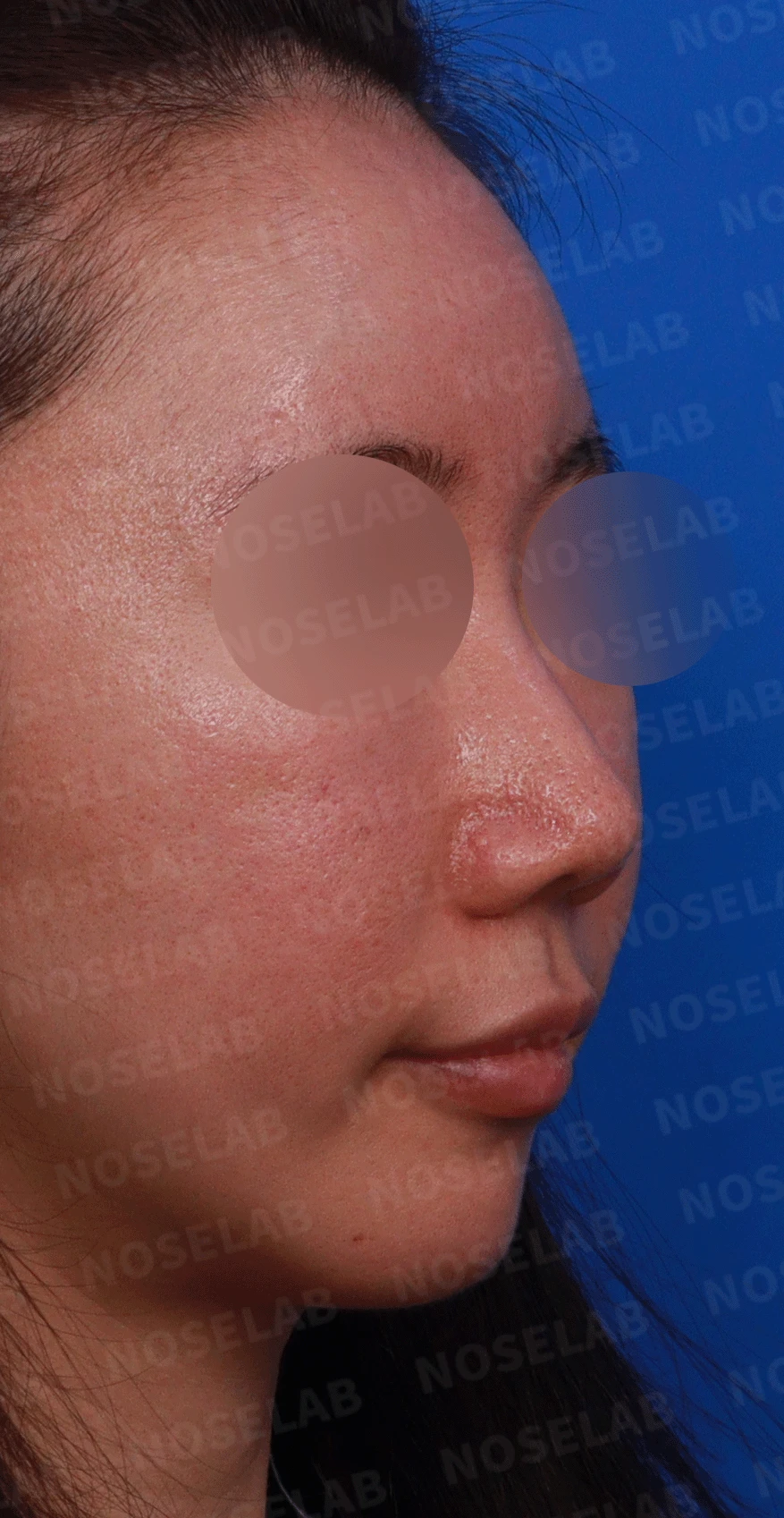 오래된 코 수술 뒤 비주가 함몰되고 코끝이 뭉툭해지는 이유와 재건 방법 — 디자인 상담 우측 비스듬한 측면, 측면, 비공 사진