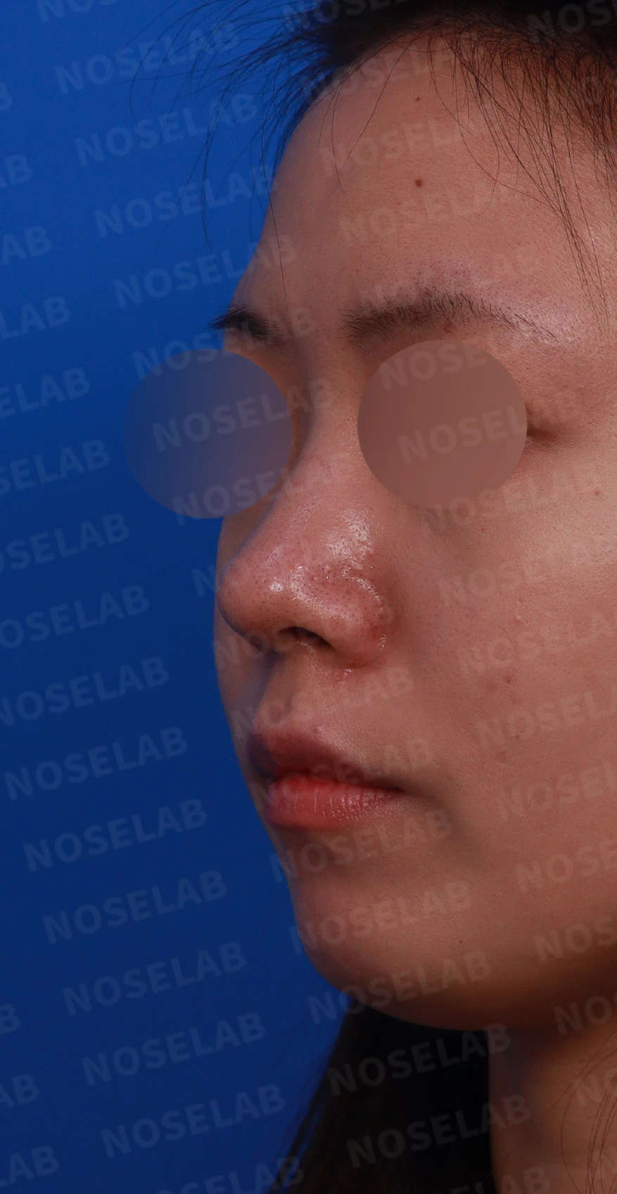 재수술 뒤에도 복코와 퍼진 코끝이 남는 이유, 자가 늑연골 재건은 어떻게 하나 — 디자인 상담 정면, 좌측 측면, 비스듬한 측면 사진