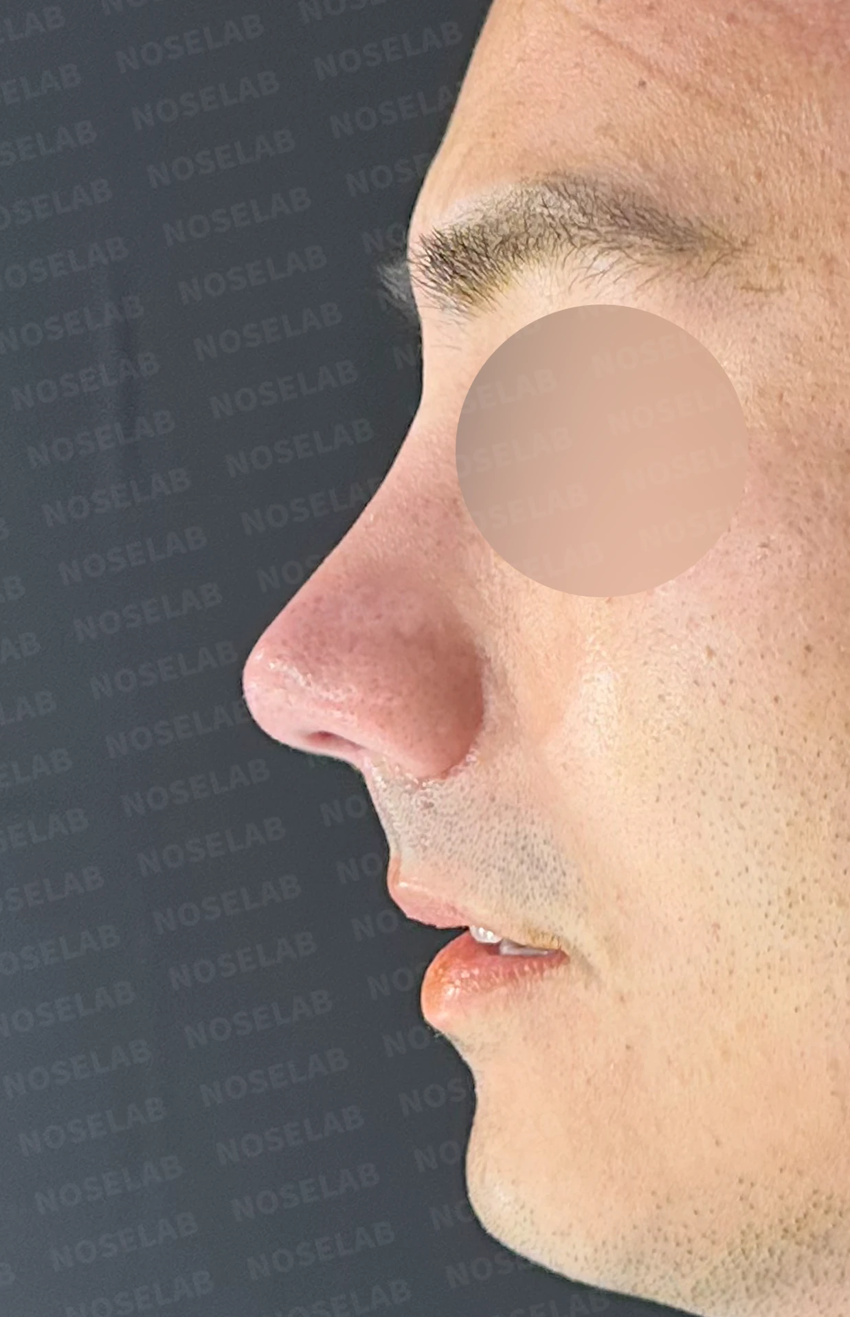 복코에 비공 비대칭과 코막힘이 함께 오는 이유, 직반 라인 교정은 어떻게 하나 — 수술 전 / 수술 직후 0일 직후 사진은 부기가 있는 상태로 최종 결과와 다를 수 있습니다.