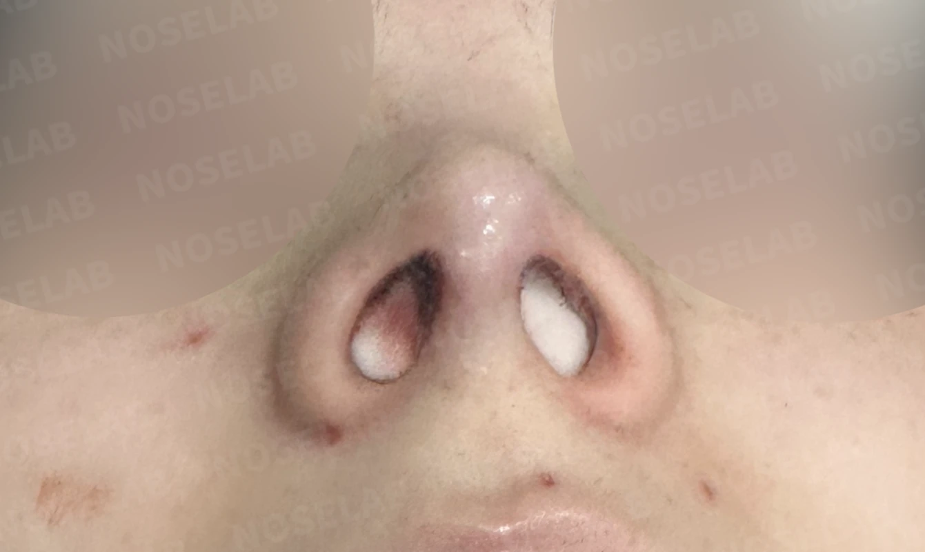 자가늑연골 코끝 성형과 매부리코·비순각 교정, 자연스럽고 화사한 코 라인 완성 — 전(좌) 직후(후)