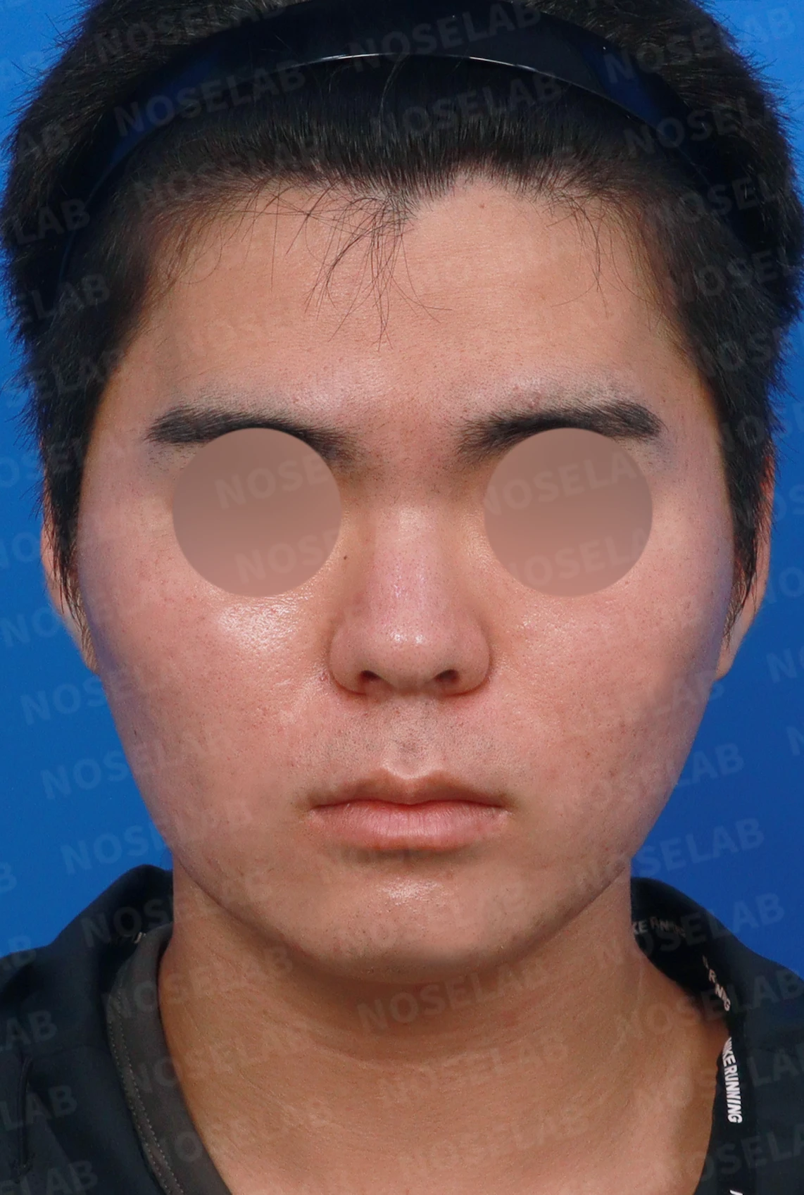 짧고 들려 보이는 작은 코, 왜 무리하게 높이지 않는가 — 디자인 상담 정면, 좌측 측면, 비스듬한 측면 사진입니다.