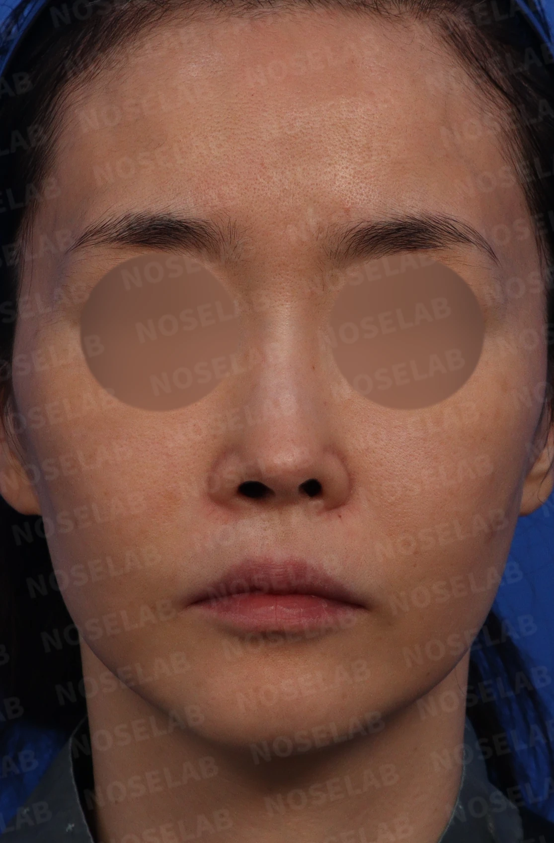 휜코와 콧구멍 비대칭의 재수술 방법 — 수술전 디자인 상담 정면, 좌측 비스듬한 측면, 측면 사진입니다.