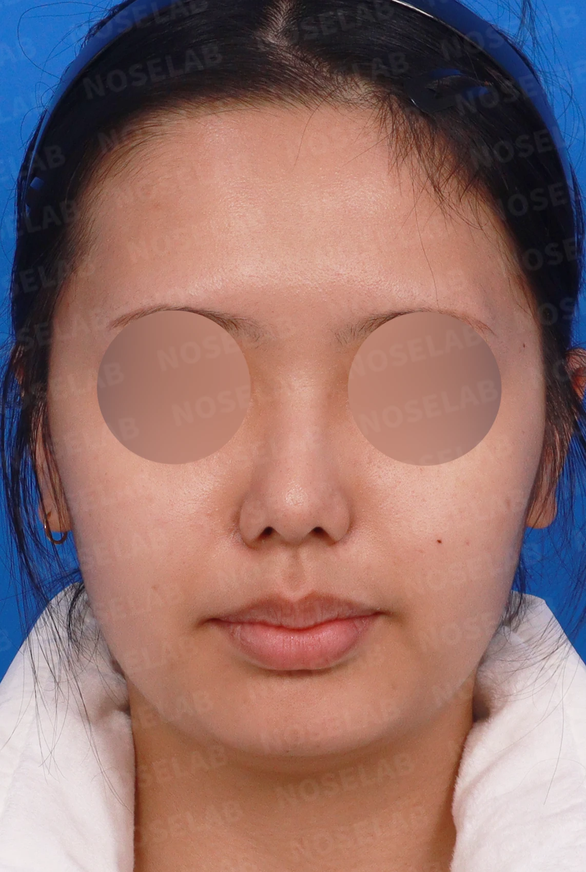 휘어진 매부리와 처진 코끝이 생기는 이유, 비중격 연장술은 어떻게 하나 — 디자인 상담 정면, 좌측 측면, 비스듬한 측면 사진입니다.