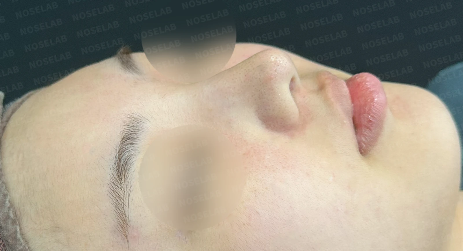 퍼진 코 개선과 콧구멍 비대칭 교정 방법 — 본문 사진 11