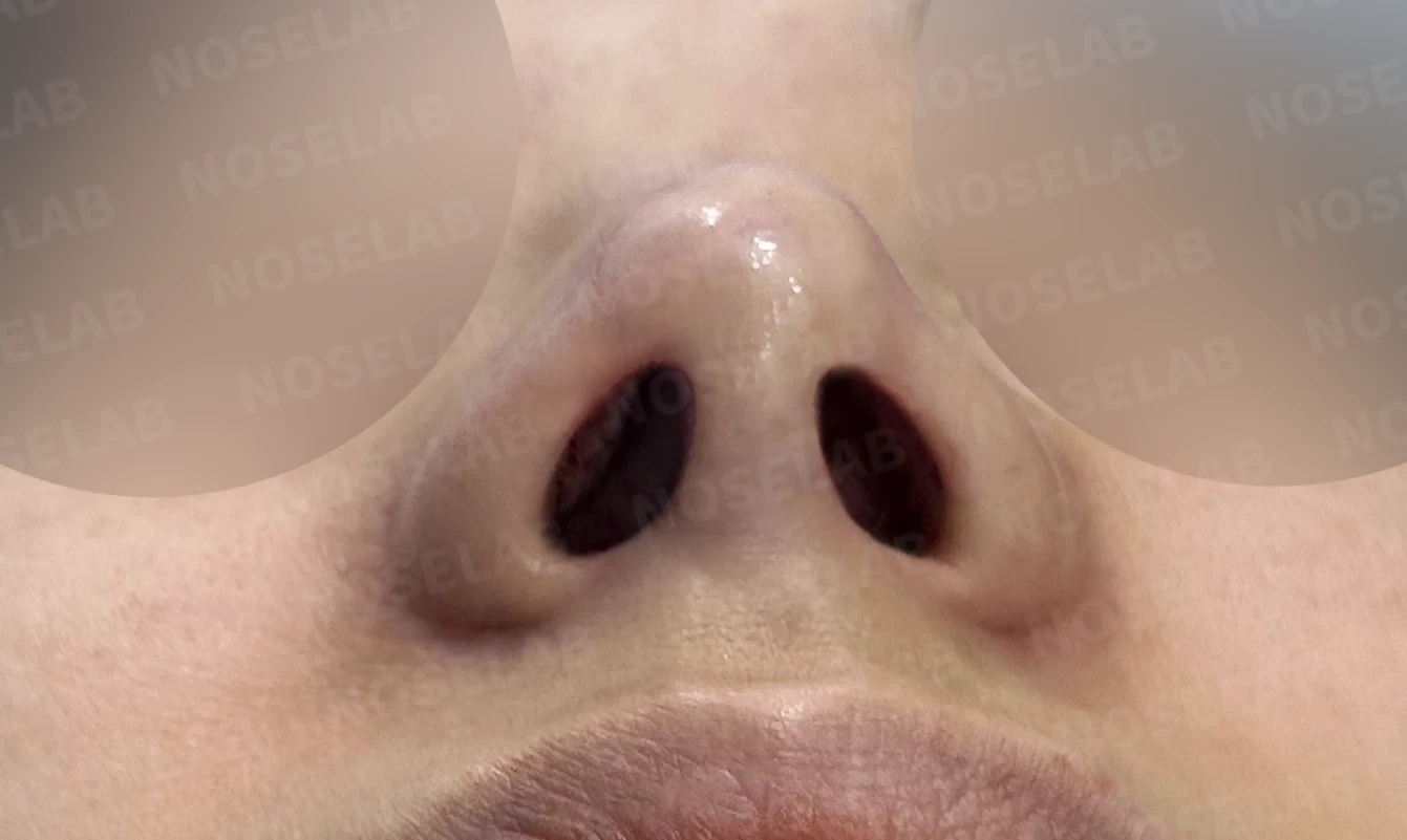 콧대 인공진피가 매부리로 남는 이유와 제거 후 재건 방법 — 수술 직후 0일 비공 사진입니다. 직후 사진은 부기가 있는 상태로 최종 결과와 다를 수 있습니다.