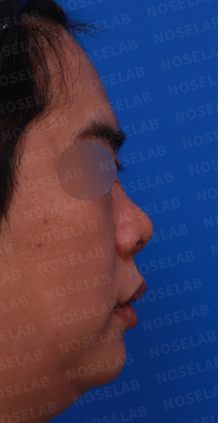 들린 코와 코막힘, 늑연골로 지지 구조를 재건하는 방법 — 디자인 상담 우측 측면, 비스듬한 측면, 비공 사진