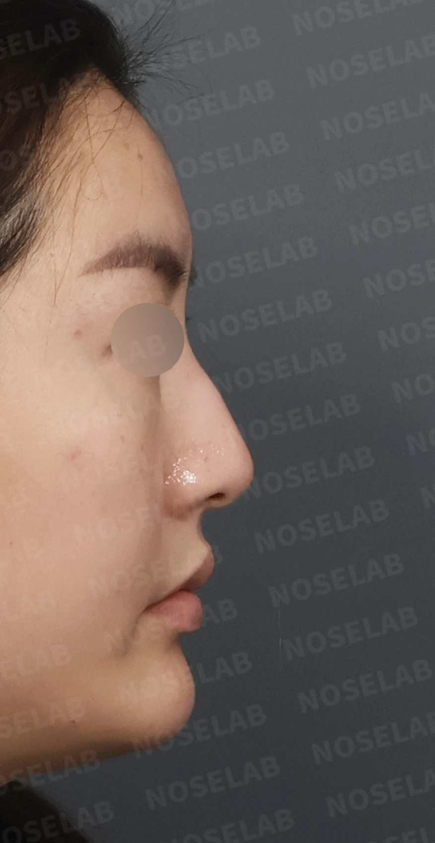 매부리코 교정, 자가늑연골로 자연스러운 코 라인 완성 — 디자인 상담 우측 측면, 비스듬한 측면, 비공 사진입니다.