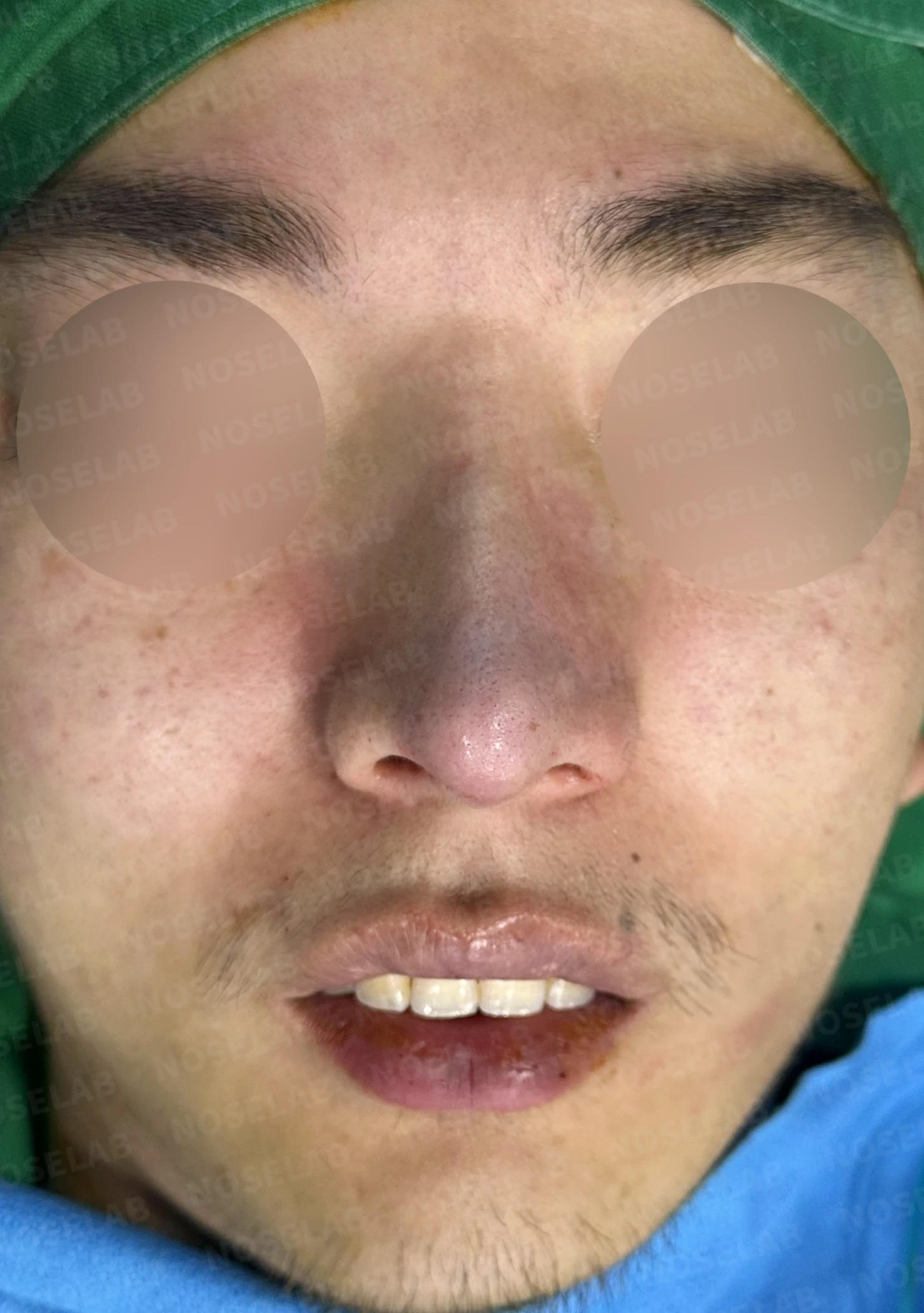 짧고 들린 코, 자가늑연골로 남성적인 라인으로 완성한 코재수술 — 수술직후 정면, 비스듬한 측면, 측면 사진입니다.