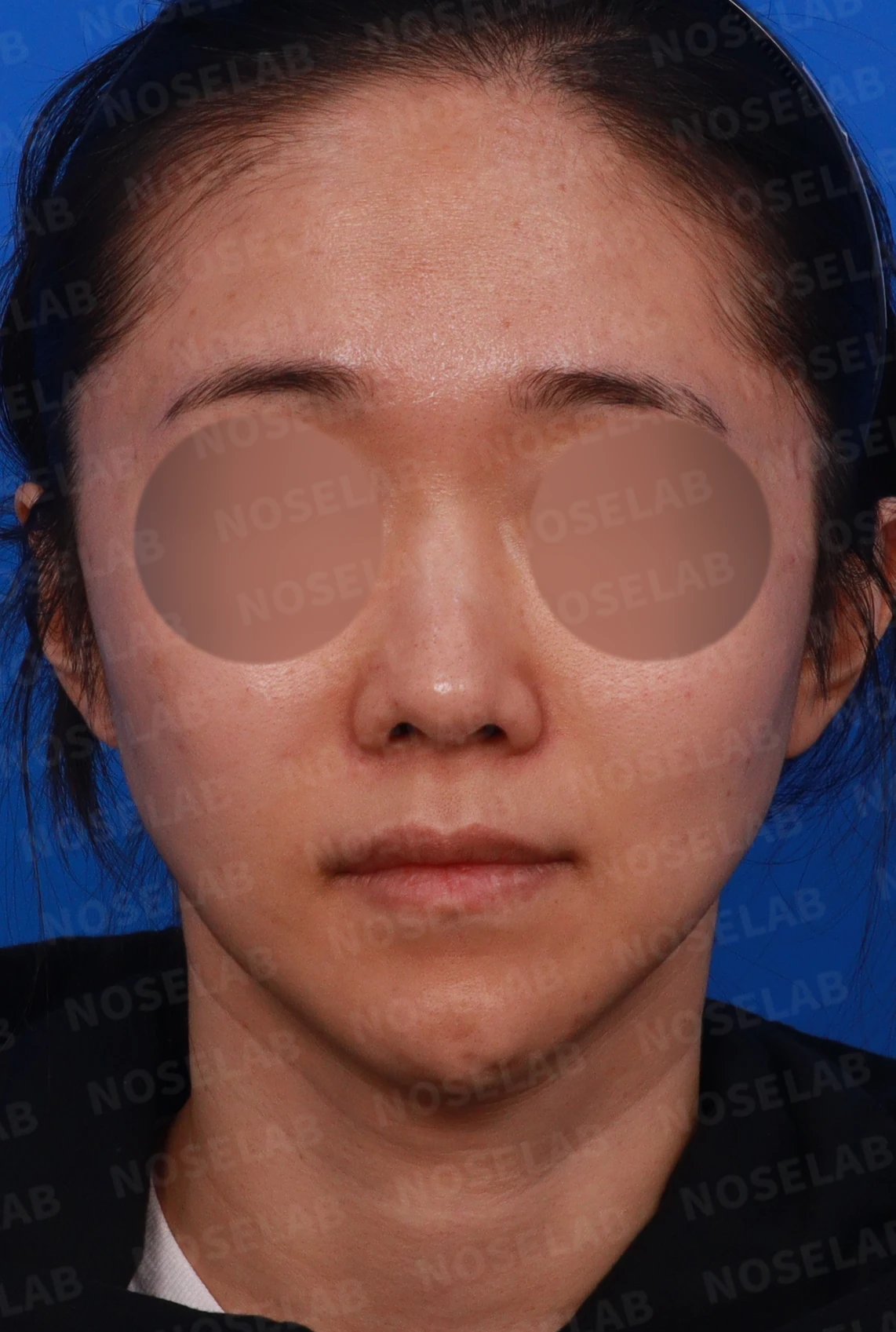 비중격 연골이 약해진 코, 보형물 없이 재건하는 방법 — 디자인 상담 정면, 좌측 측면, 비스듬한 측면 사진