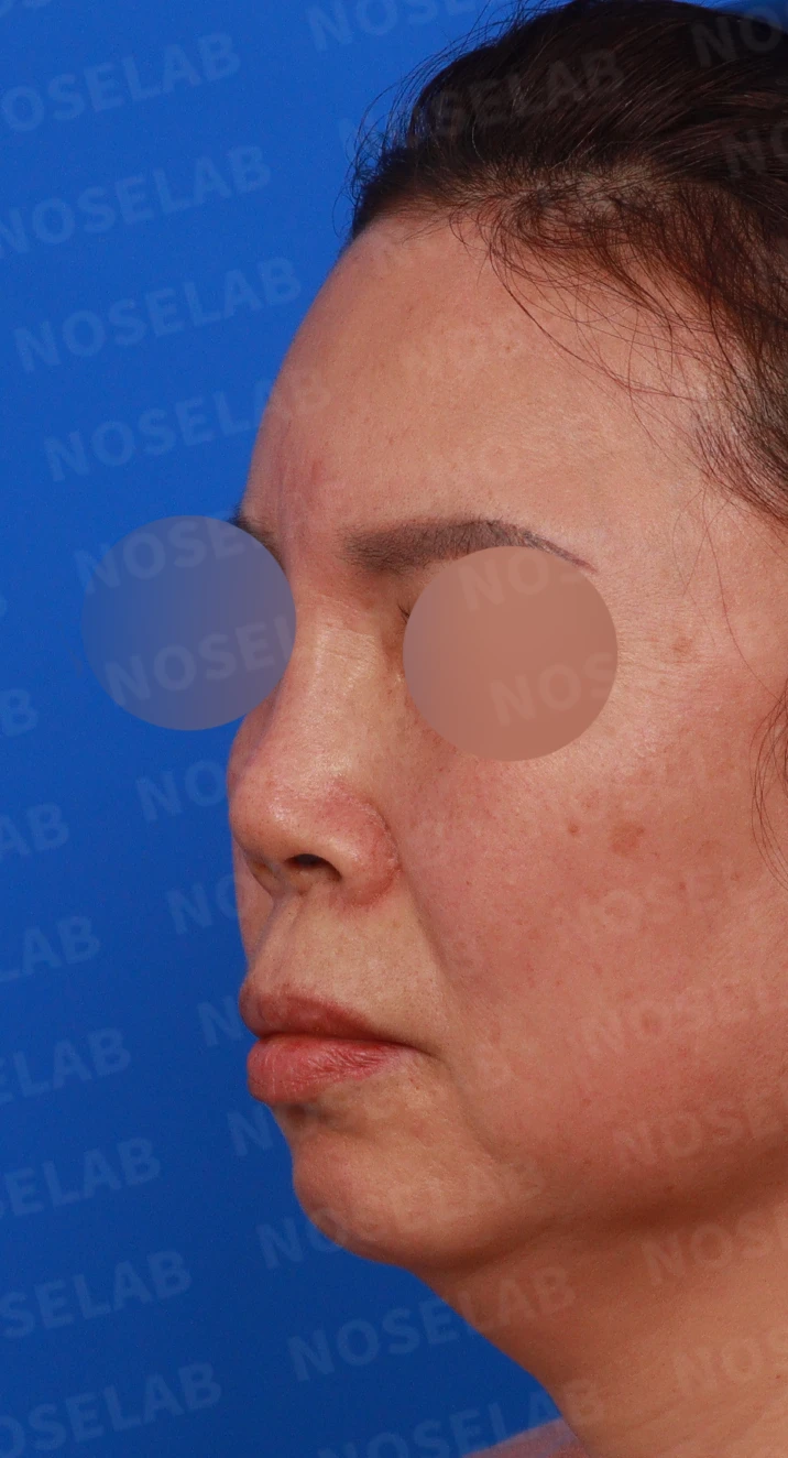 불법 주사 시술 뒤 코가 들리고 짧아지는 이유, 이물질 제거와 재건은 어떻게 하나 — 디자인 상담 정면, 좌측 측면, 비스듬한 측면 사진