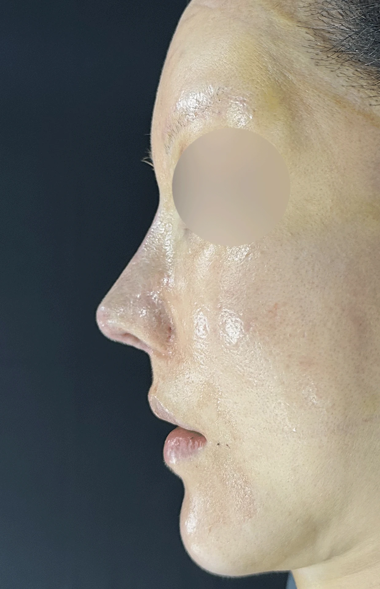 여러 차례 재수술로 코에 쓸 연골이 남지 않았을 때, 재건은 어떻게 하나 — 본문 사진 10