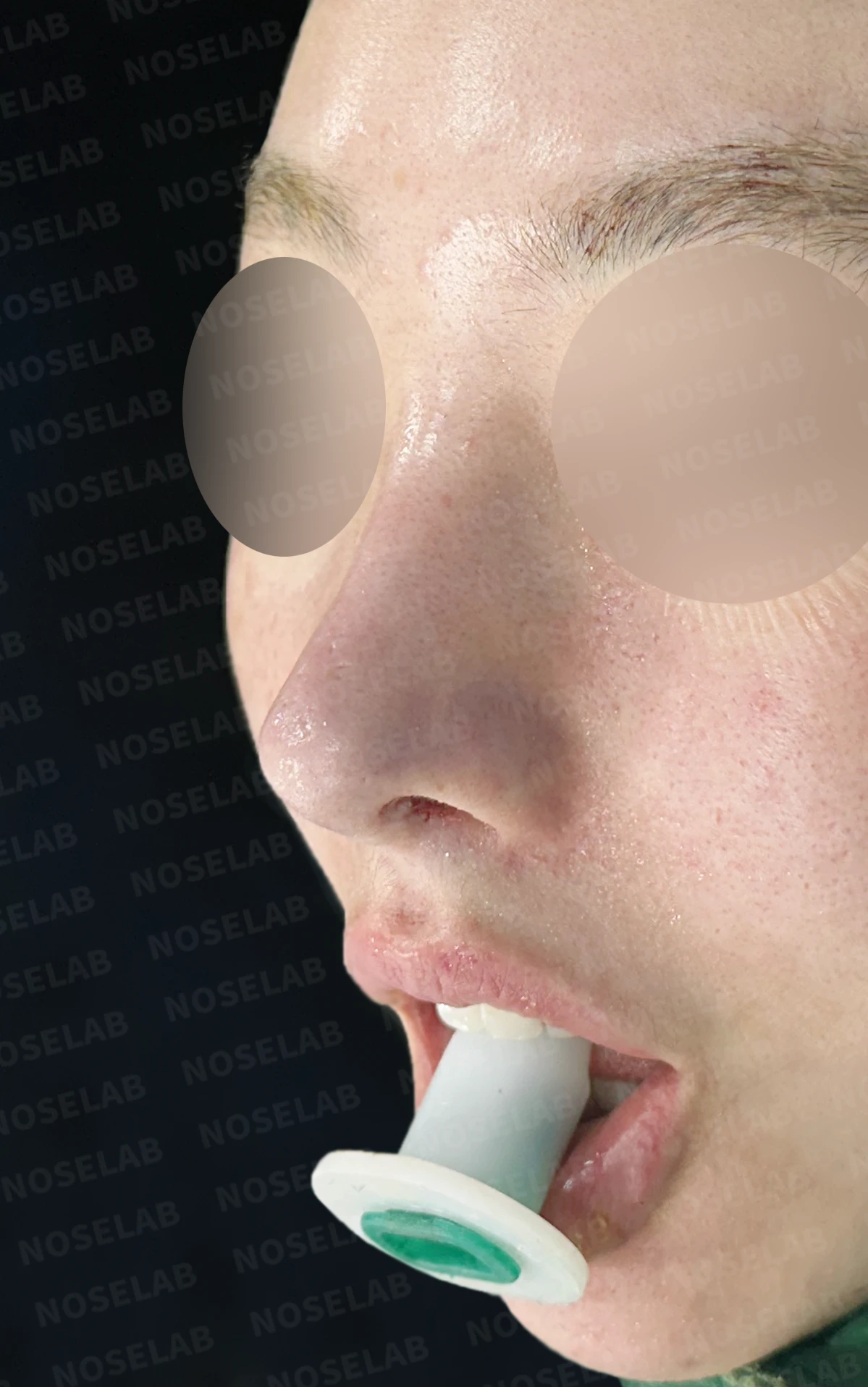 이물질 제거와 자가늑연골 비중격 재건, 들린 코 교정한 코재수술 — 직후 정면, 비스듬한 측면, 측면 사진입니다.