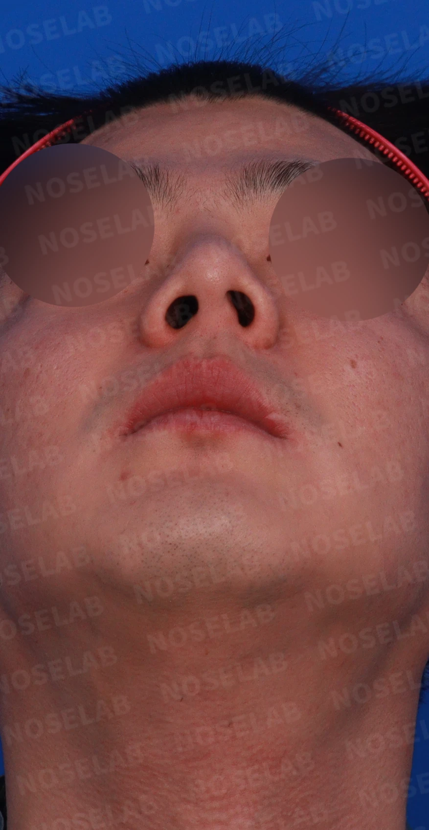 콧구멍 비대칭과 들린 코가 함께 생기는 이유, 늑연골 재건은 어떻게 하나 — 디자인 상담 우측 비스듬한 측면, 측면, 비공 사진