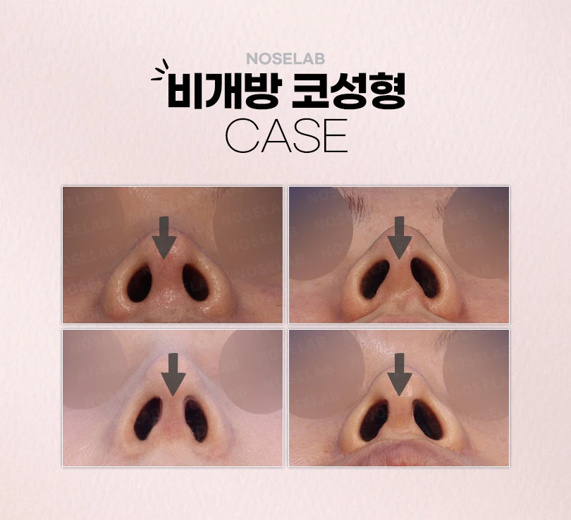 강차영원장의 고난도 코재수술 비개방코성형 수술 방법 — 본문 사진 4
