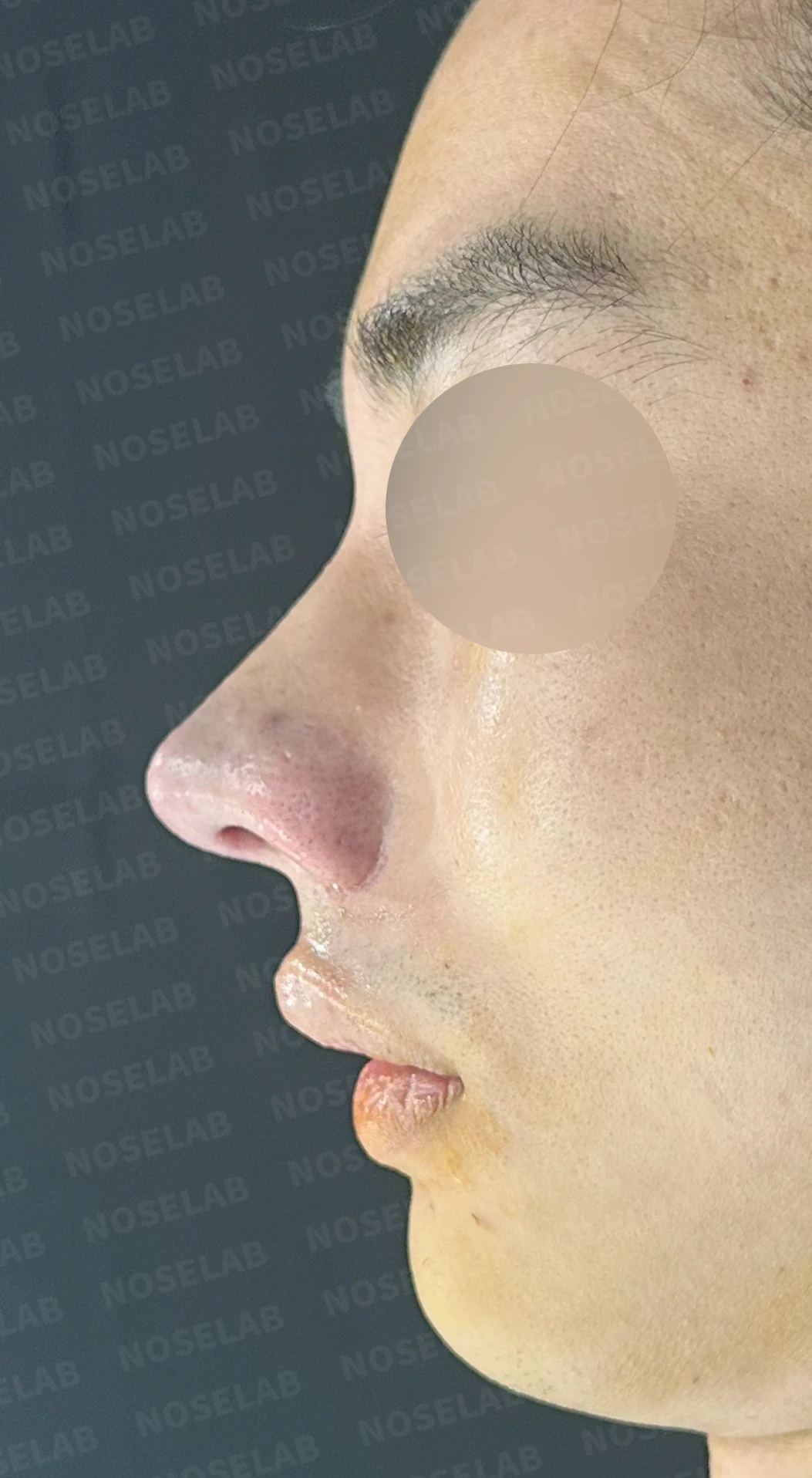 코뼈 골절에 미용 수술을 함께 할 수 있는 경우와 단계로 나누는 방법 — 수술 직후 0일 정면, 측면, 비스듬한 측면 사진 직후 사진은 부기가 있는 상태로 최종 결과와 다를 수 있습니다.