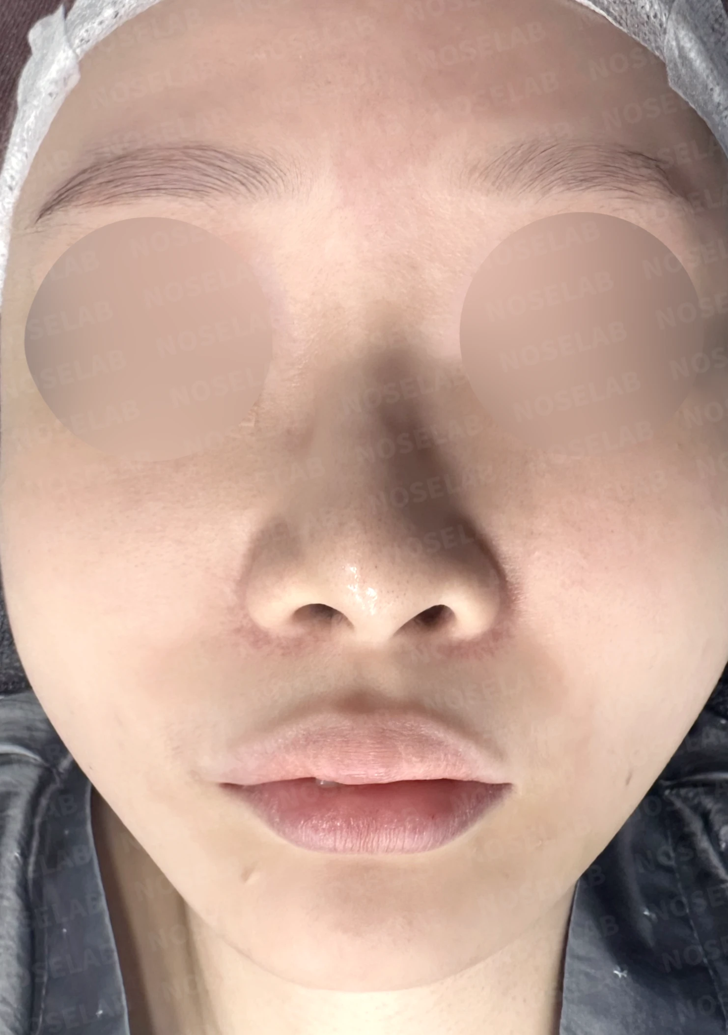 절골 부위가 과하게 깎이면 코가 왜 휘어 보이는가, 코뼈 복원과 코끝 재건 — 수술 전 / 수술 직후 0일 직후 사진은 부기가 있는 상태로 최종 결과와 다를 수 있습니다.