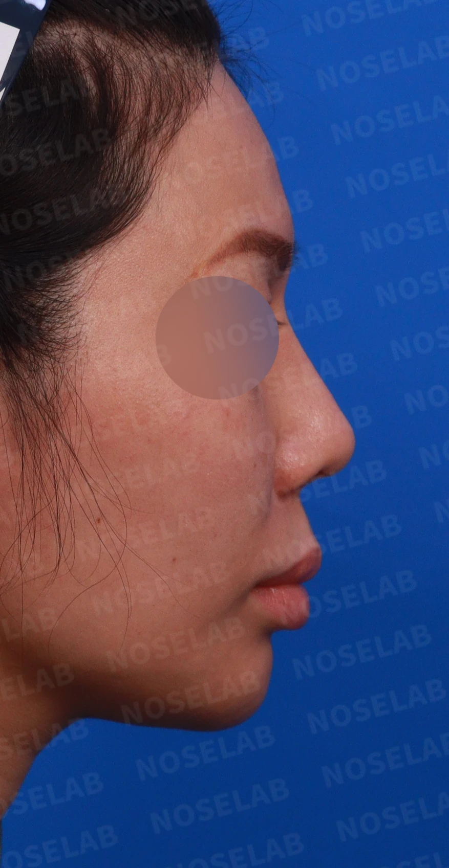 실리텍스 보형물이 비쳐 보이는 이유와 제거 후 재건은 어떻게 하나 — 디자인 상담 우측 측면, 비스듬한 측면, 비공 사진입니다.