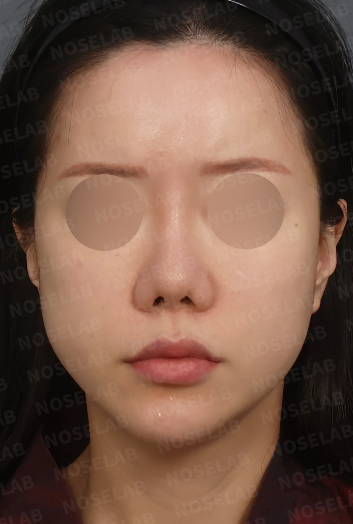 짧은 코와 복코, 자가늑연골로 세련되게 교정한 코재수술 — 디자인 상담 정면, 좌측 측면, 비스듬한 측면 사진입니다.