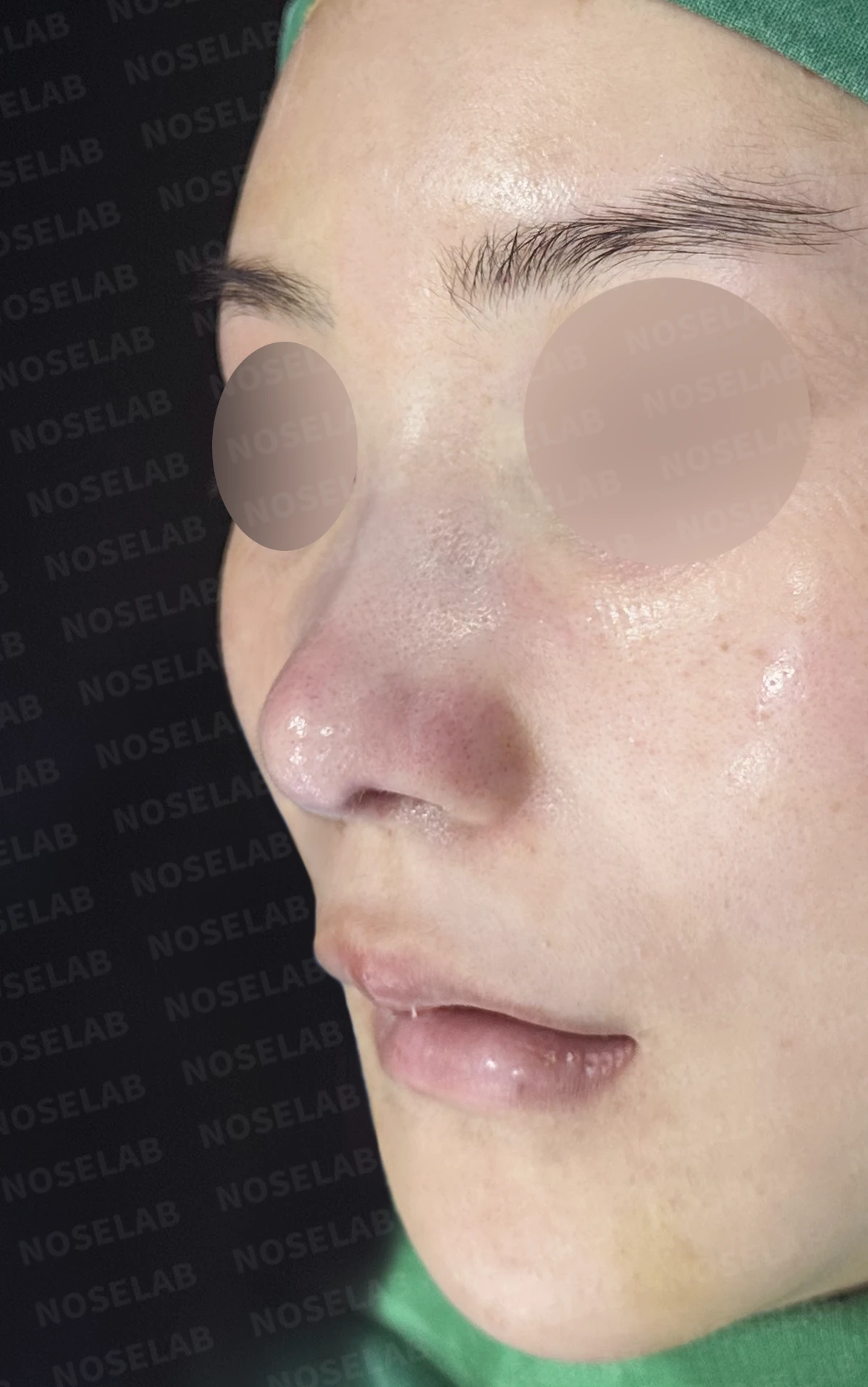 들린 코와 한쪽만 찝힌 콧구멍이 생기는 이유, 무보형물 재건은 어떻게 하나 — 수술 직후 0일 정면, 비스듬한 측면, 측면 사진입니다. 직후 사진은 부기가 있는 상태로 최종 결과와 다를 수 있습니다.