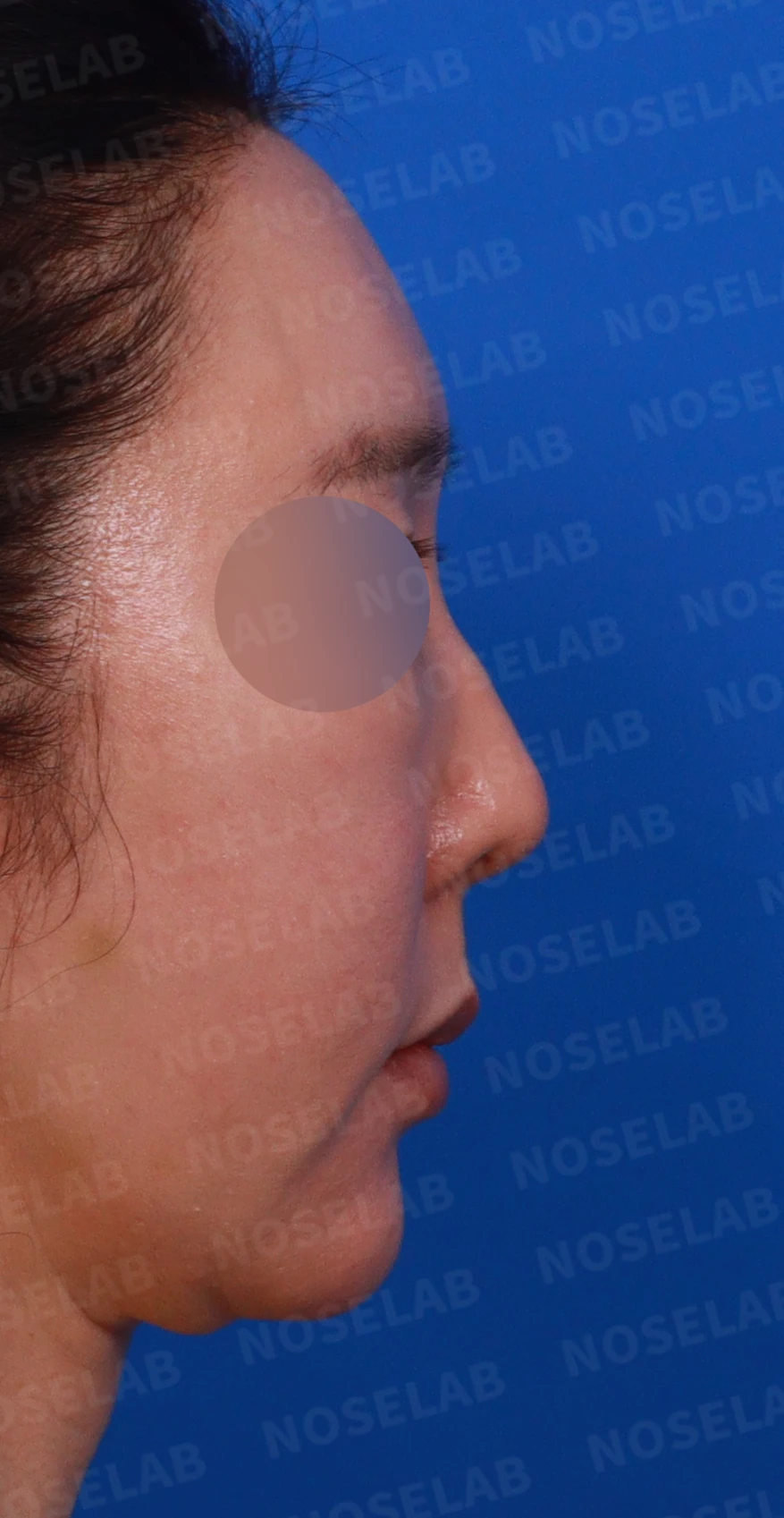 매부리를 깎은 뒤 다시 매부리가 보이고 콧구멍이 드러나는 이유 — 디자인 상담 정면, 좌측 측면, 측면 사진