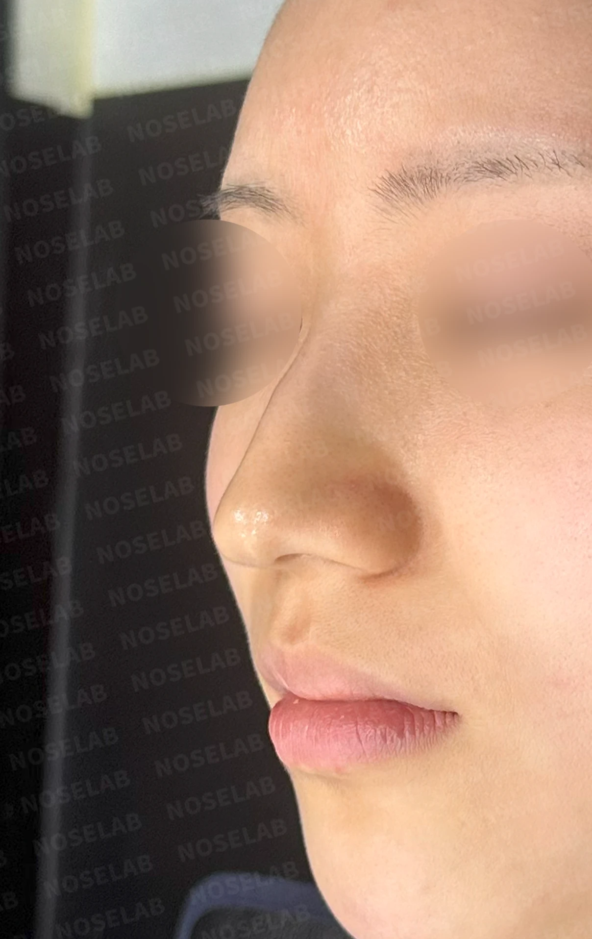매부리코와 긴 코에 코막힘이 겹치는 이유, 교정은 어떻게 하나 — 수술 전 / 수술 직후 0일 직후 사진은 부기가 있는 상태로 최종 결과와 다를 수 있습니다.