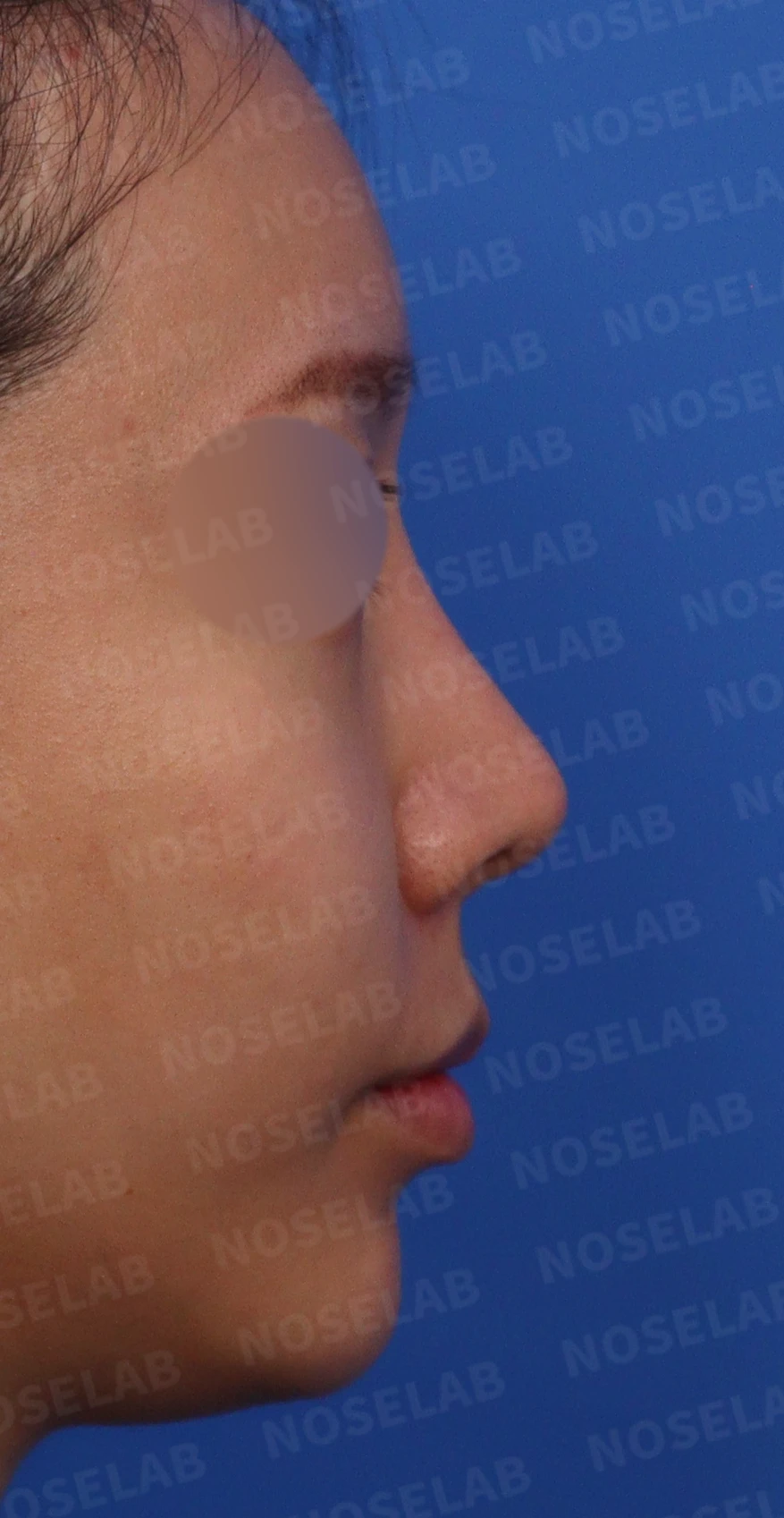 휜코와 콧구멍 비대칭, 호흡을 함께 고려한 교정 방법 — 수술전 디자인 상담 정면, 비스듬한 측면, 측면 사진입니다.