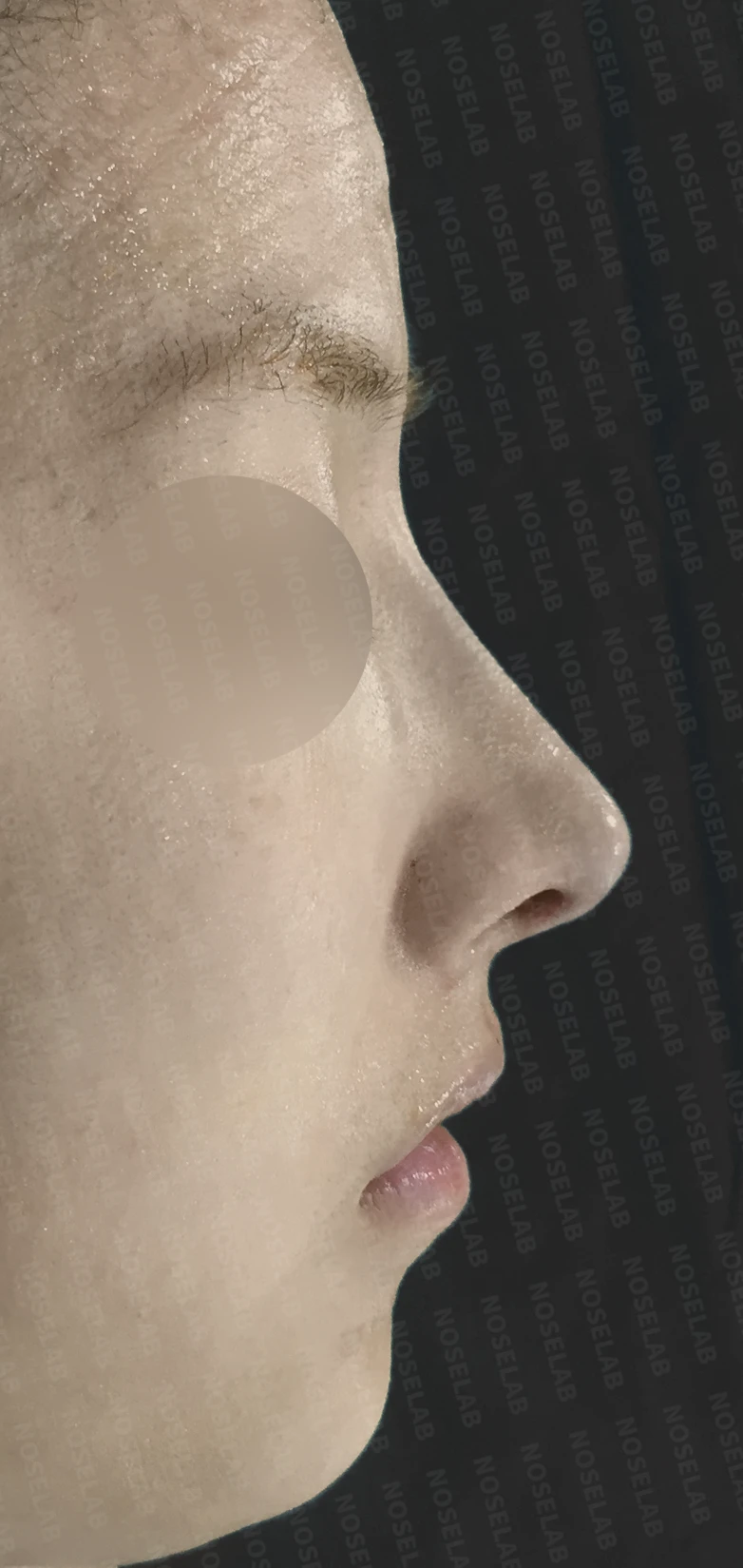 긴 코와 매부리코, 얼굴 비율을 고려한 교정 방법 — 수술 직후 0일 정면, 측면, 비스듬한 측면 사진입니다. 직후 사진은 부기가 있는 상태로 최종 결과와 다를 수 있습니다.