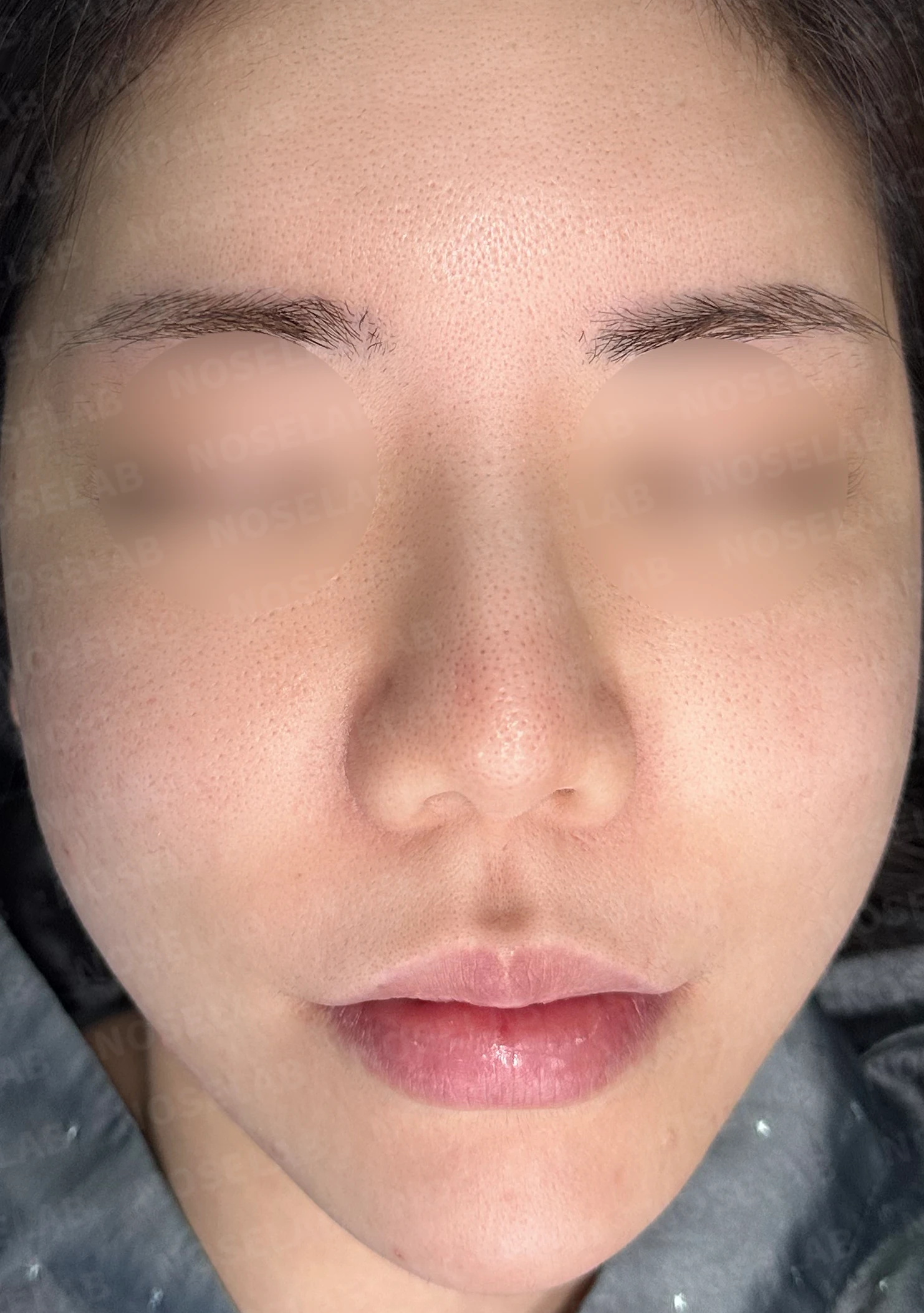복코 교정과 비주 내리기 방법 — 수술 전 / 수술 직후 0일 직후 사진은 부기가 있는 상태로 최종 결과와 다를 수 있습니다.