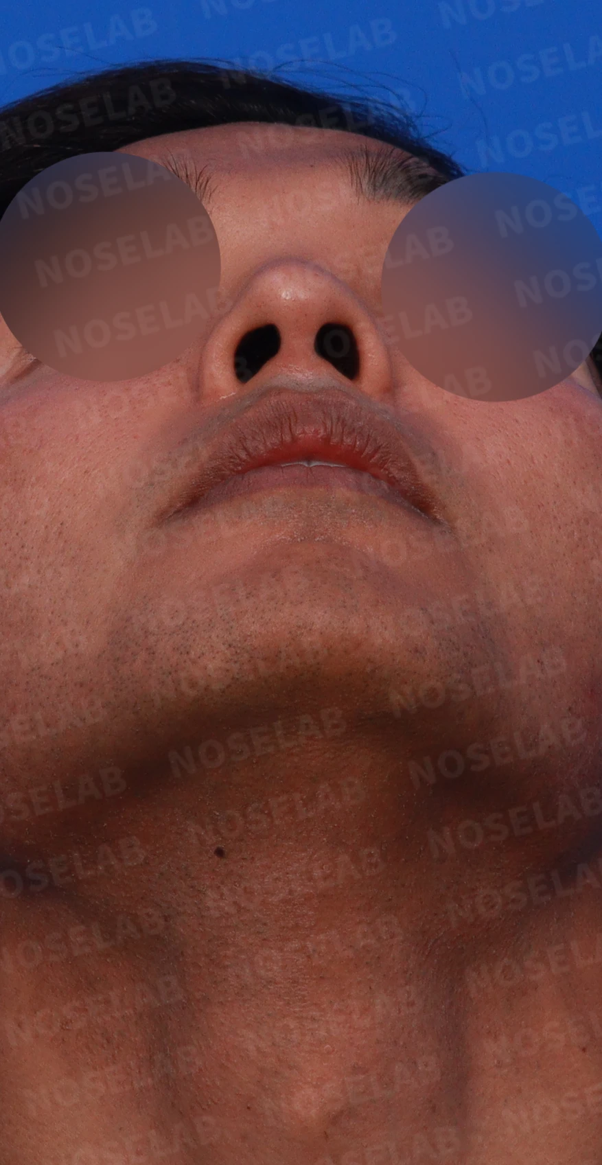 코가 퍼져 보이면서 코막힘이 함께 오는 이유, 절골과 자가 늑연골 교정 방법 — 디자인 상담 우측 비스듬한 측면, 측면, 비공 사진