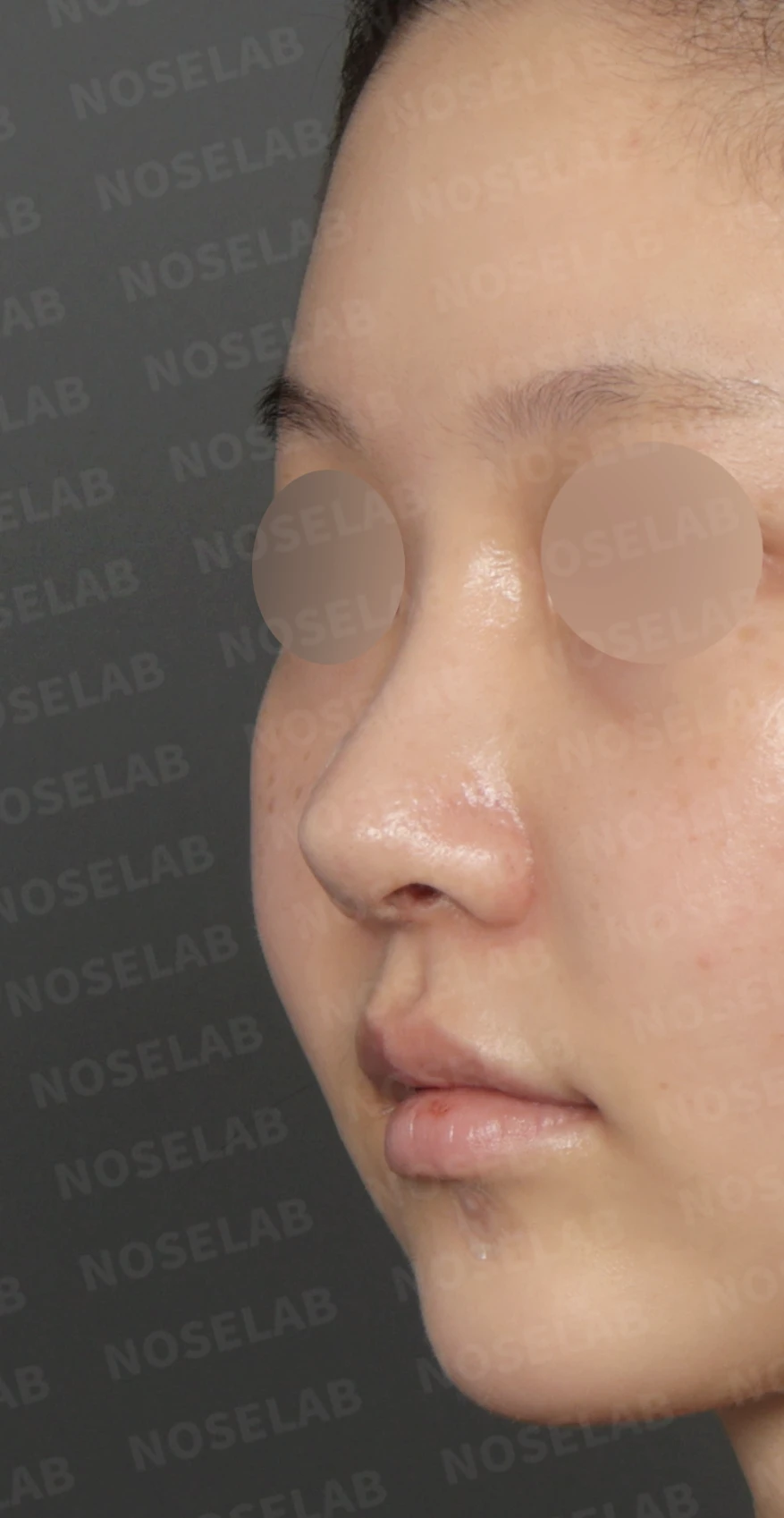 휘어진 코와 복코, 자가늑연골 비중격 재건으로 안전하게 교정한 코재수술 — 디자인 상담 정면, 비스듬한 측면 , 측면 사진입니다.