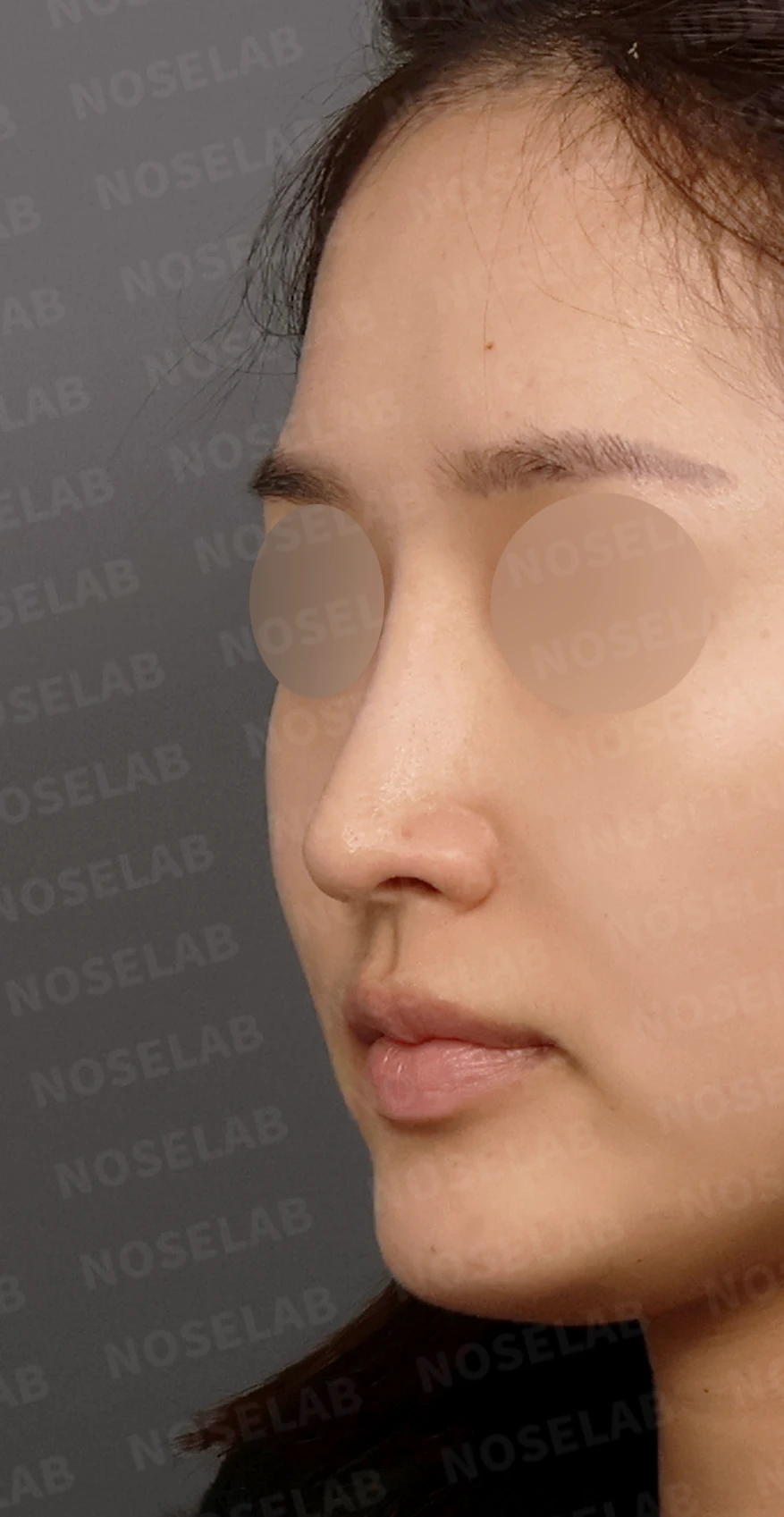 코성형 뒤 코끝이 처져 코가 길어 보이는 이유, 자가늑연골 코끝 재건 방법 — 디자인 상담 정면, 좌측 측면, 비스듬한 측면 사진입니다.