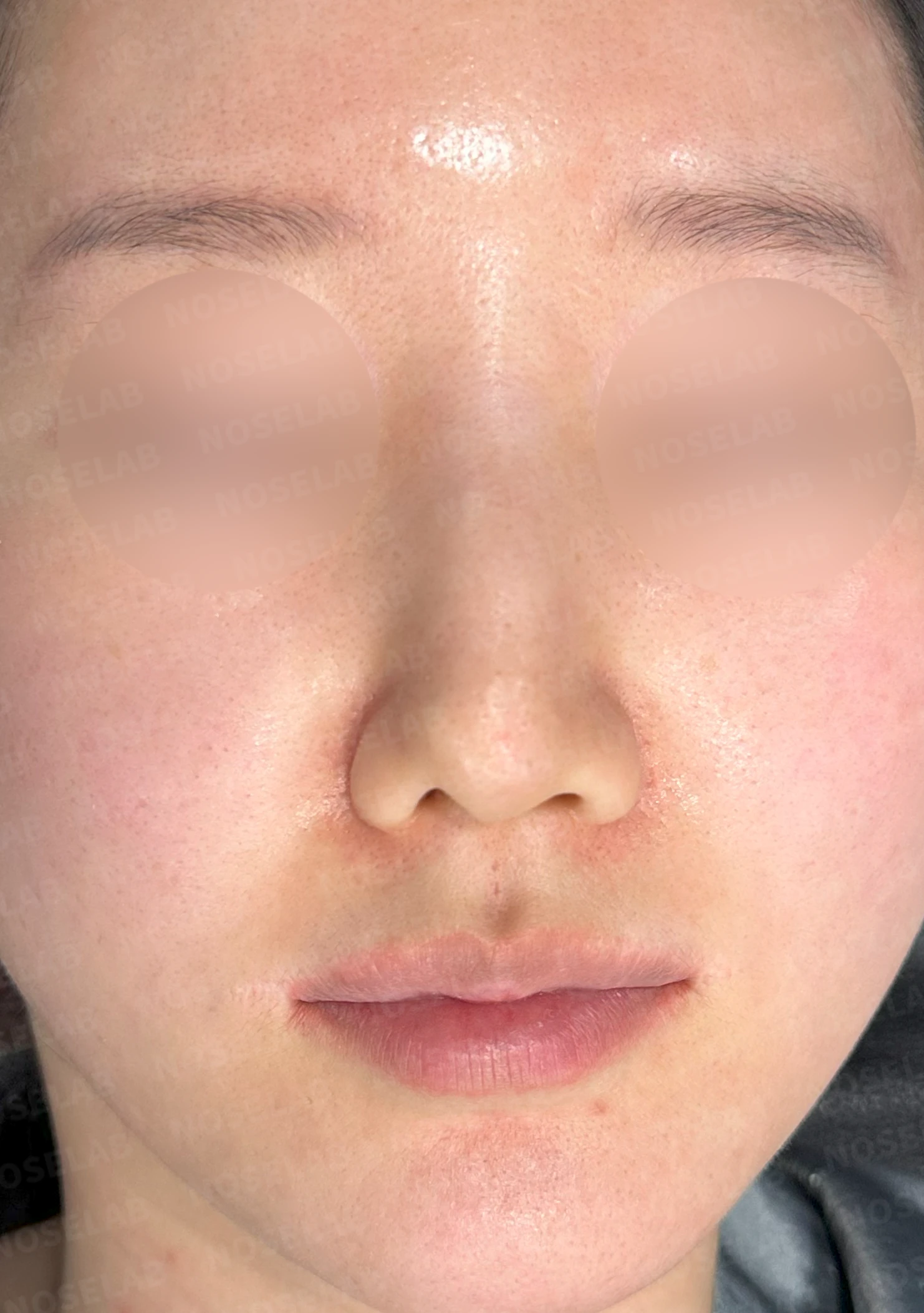 비공 비대칭과 코끝 처짐은 왜 생기나, 연골을 병용한 재건 방법 — 수술 전 / 수술 직후 0일 직후 사진은 부기가 있는 상태로 최종 결과와 다를 수 있습니다.