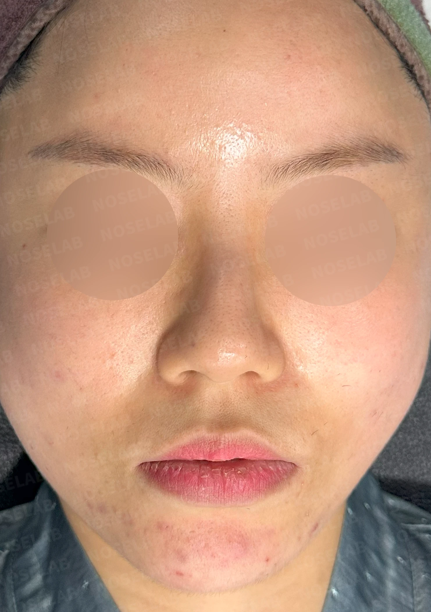 녹지 않고 남은 코 필러와 넓은 콧날개, 원인과 제거·교정 방법 — 수술 전 / 수술 직후 0일 직후 사진은 부기가 있는 상태로 최종 결과와 다를 수 있습니다.