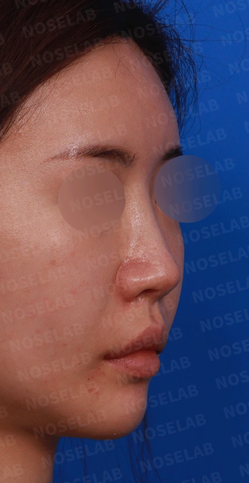 이전 수술로도 달라지지 않는 뭉툭한 코끝, 원인과 재건 방법 — 디자인 상담 우측 측면 , 비스듬한 측면 , 비공 사진입니다.