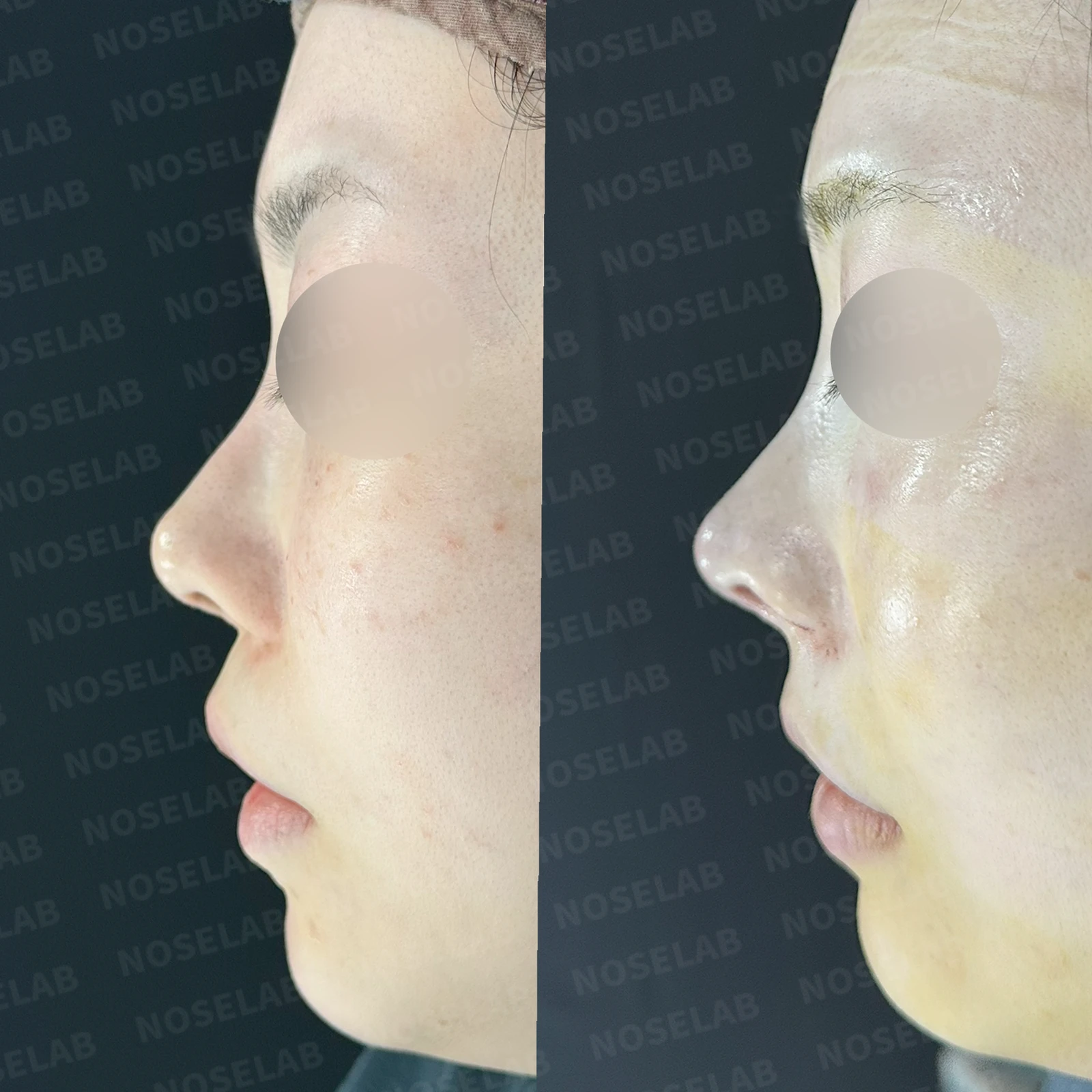 비중격 연골을 과도하게 채취하면 생기는 문제와 재건 방법 — 본문 사진 20