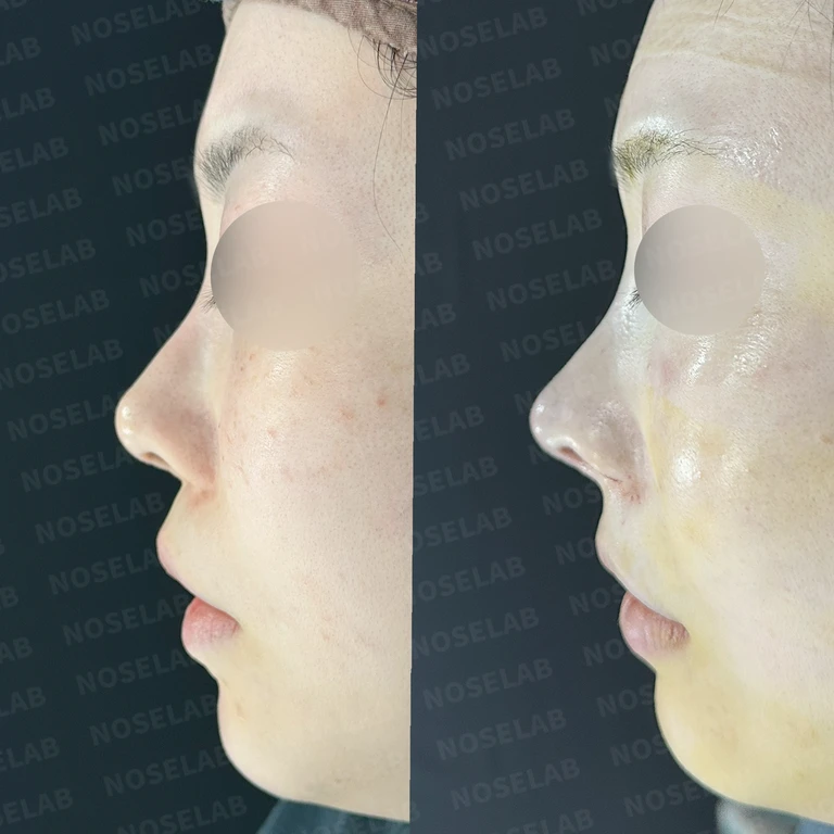 과도한 비중격연골 채취로 인한 불안정성 재건 사례 — 전후 비교
