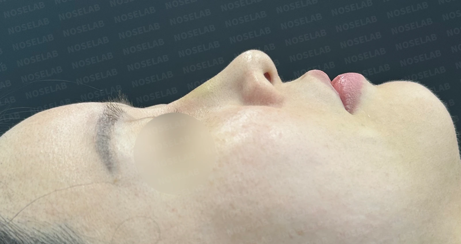 짧고 들린 코를 교정하는 재수술 방법 — 수술 전 / 수술 직후 0일 직후 사진은 부기가 있는 상태로 최종 결과와 다를 수 있습니다.