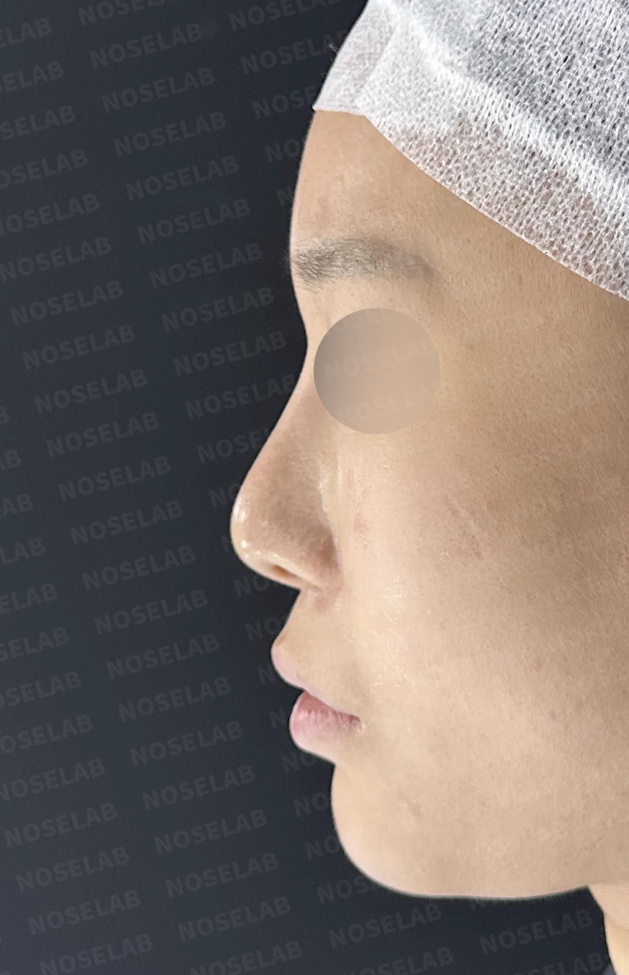 비중격 천공이 생기면 무엇이 문제이고 어떻게 재건하나 — 수술 전 / 수술 직후 0일 직후 사진은 부기가 있는 상태로 최종 결과와 다를 수 있습니다.
