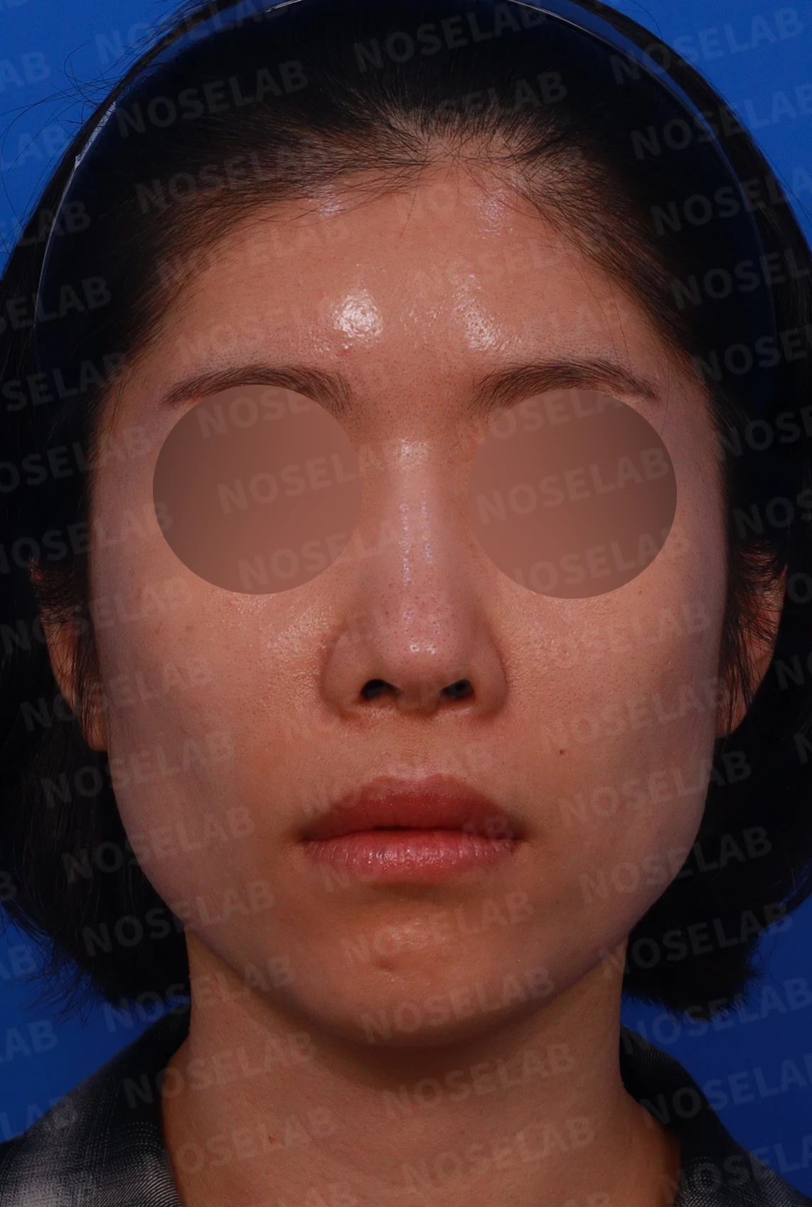 코 수술 뒤 염증이 오래 지속되면 생기는 변화와 재건 방법 — 디자인 상담 정면, 비스듬한 측면, 좌측 측면 사진입니다.