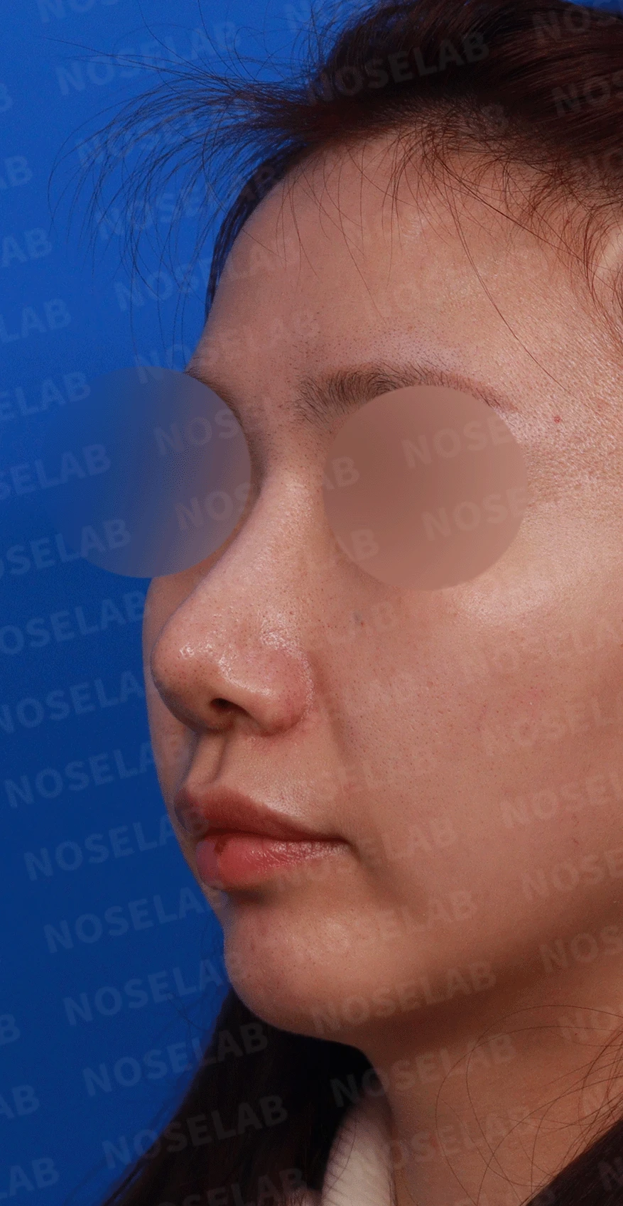 코끝 고어텍스가 문제를 일으키는 이유와 늑연골 비중격 재건 방법 — 디자인 상담 정면, 좌측 측면, 비스듬한 측면 사진입니다.