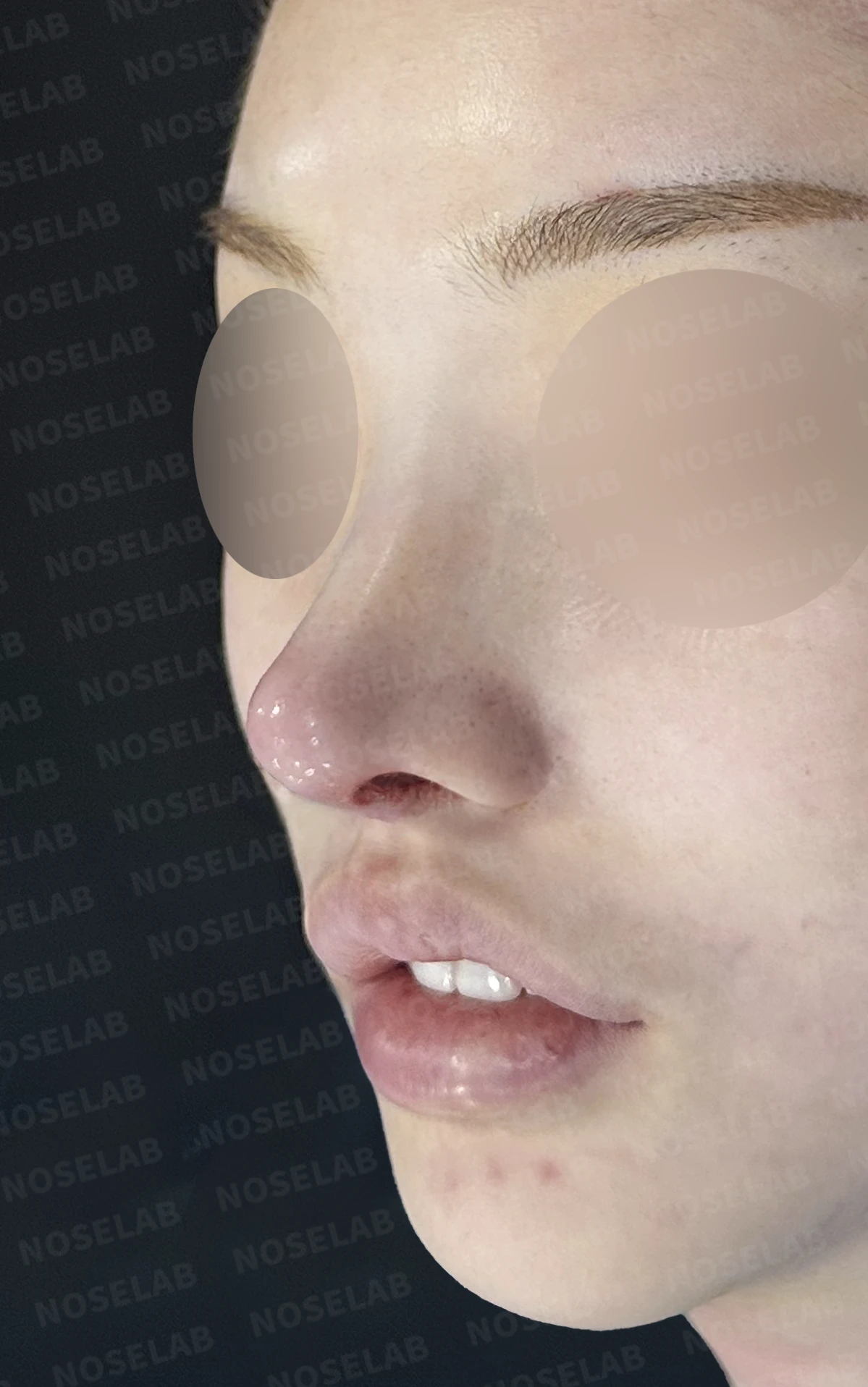 비중격이 심하게 휘고 손상되는 이유, 늑연골 재건은 어떻게 하나 — 수술 직후 0일 정면, 비스듬한 측면, 측면 사진입니다 직후 사진은 부기가 있는 상태로 최종 결과와 다를 수 있습니다.