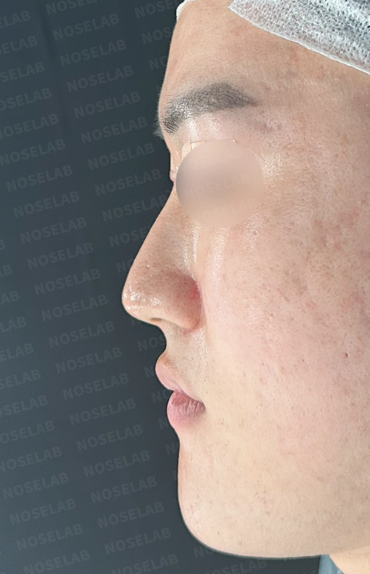 보형물 없이 코끝과 경계 부분만 교정하는 방법 — 본문 사진 9