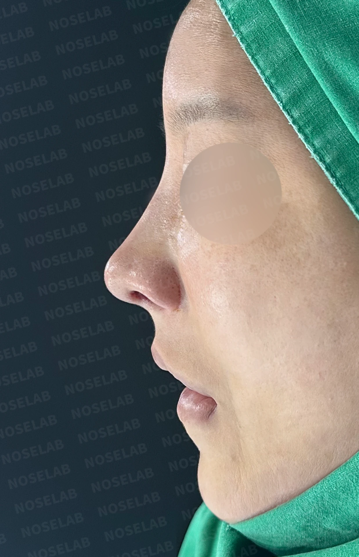 휜 코 교정과 코막힘 개선, 두 마리 토끼를 잡은 성공 사례 — 전(좌) , 직후(후)