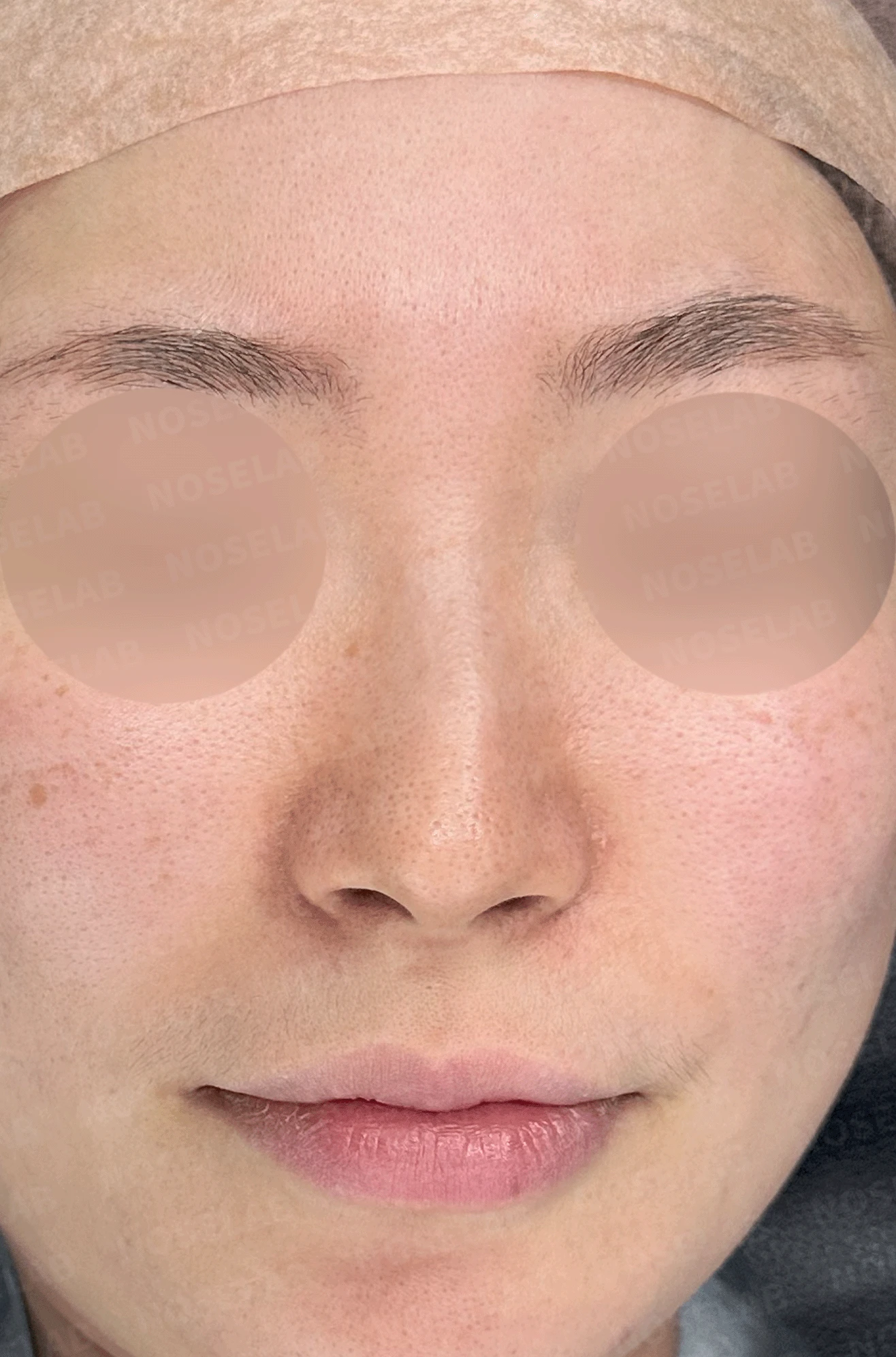 매부리코와 휜 코에 코막힘이 함께 오는 이유, 복합 교정은 어떻게 하나 — 본문 사진 7