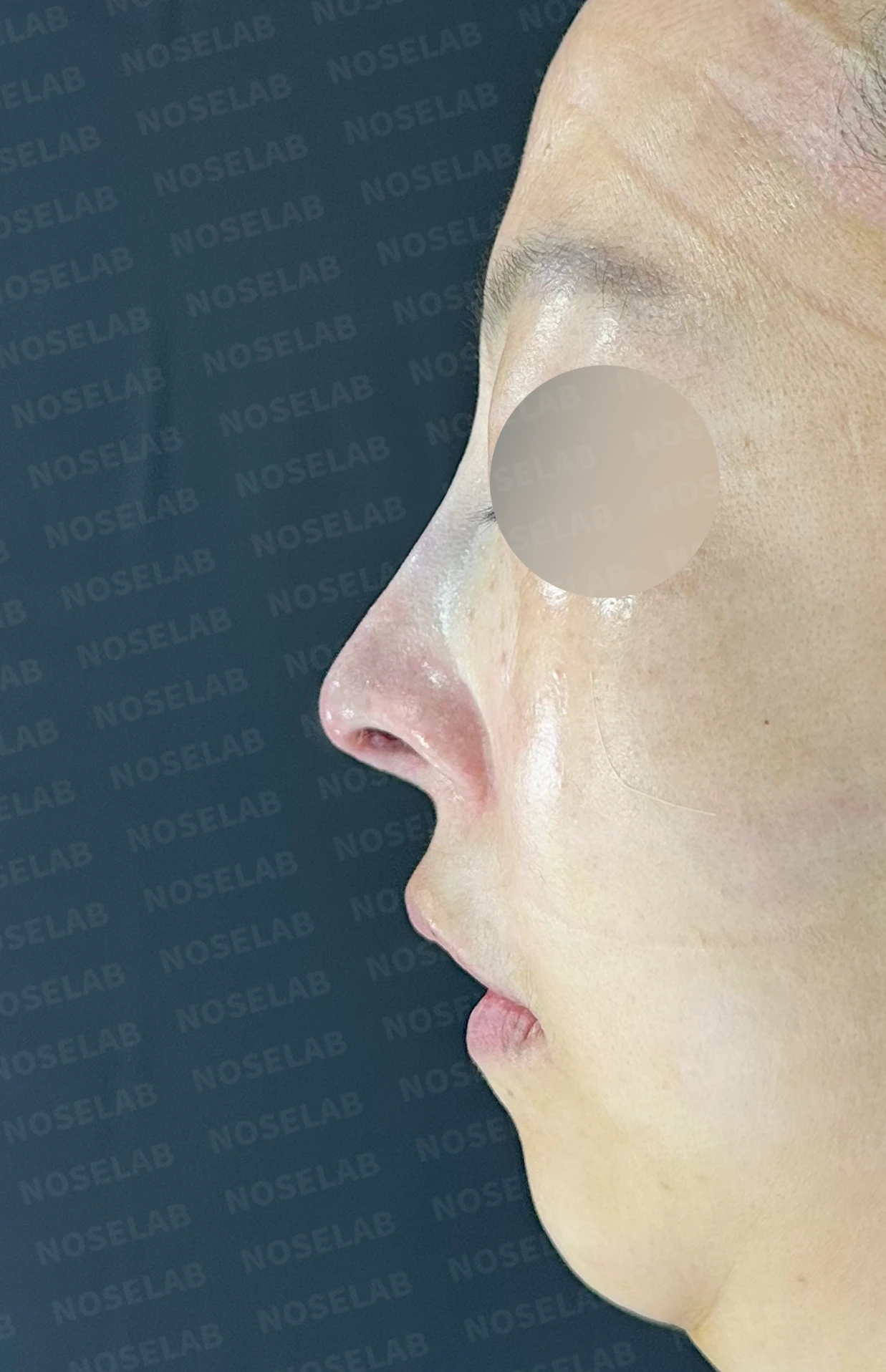 들창코에서 콧구멍이 많이 보이는 이유, 코끝 위치 교정은 어떻게 하나 — 수술 전 / 수술 직후 0일 직후 사진은 부기가 있는 상태로 최종 결과와 다를 수 있습니다.