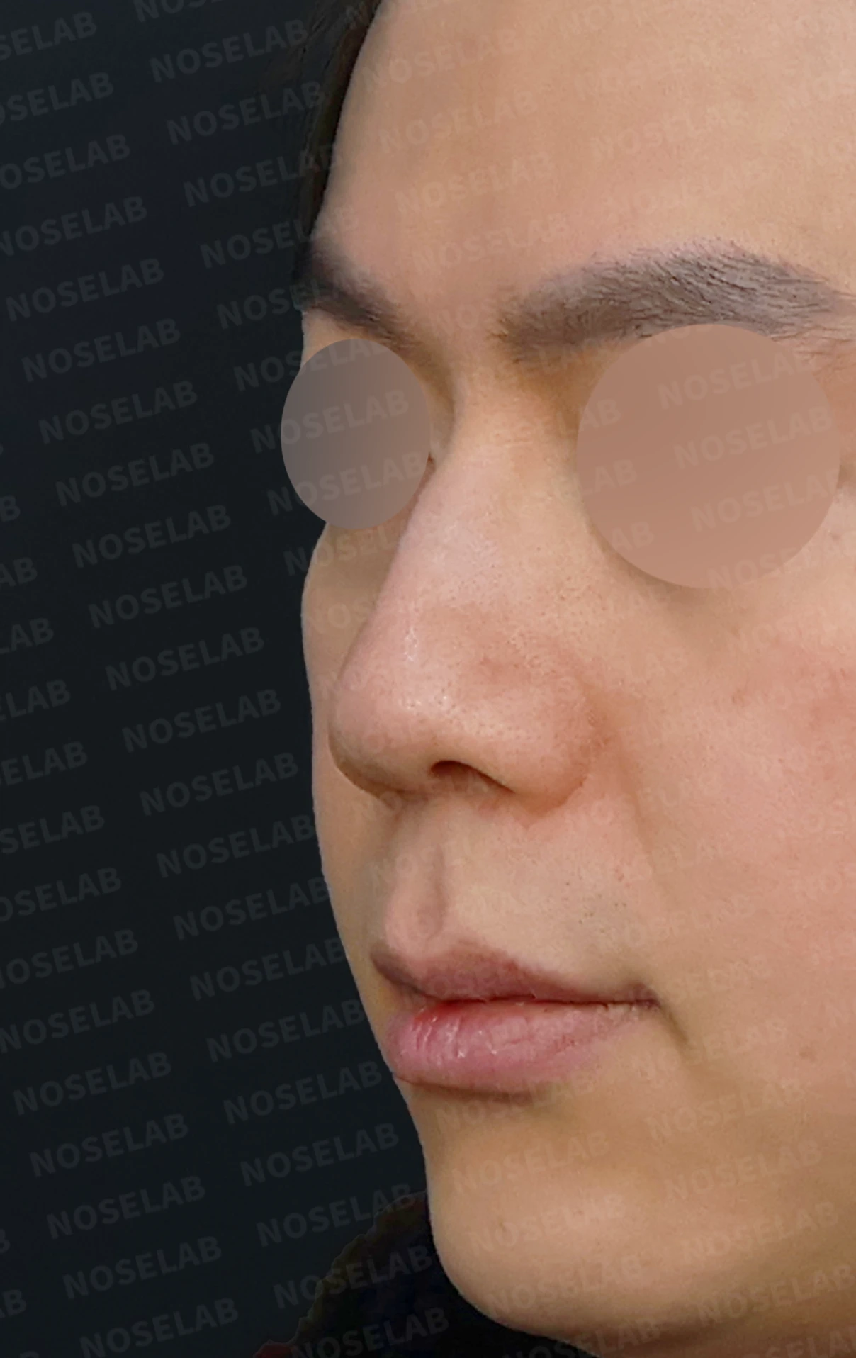 휘어진 매부리코, 자가늑연골로 교정한 남자 코성형 사례 — 전(좌) , 직후(우)